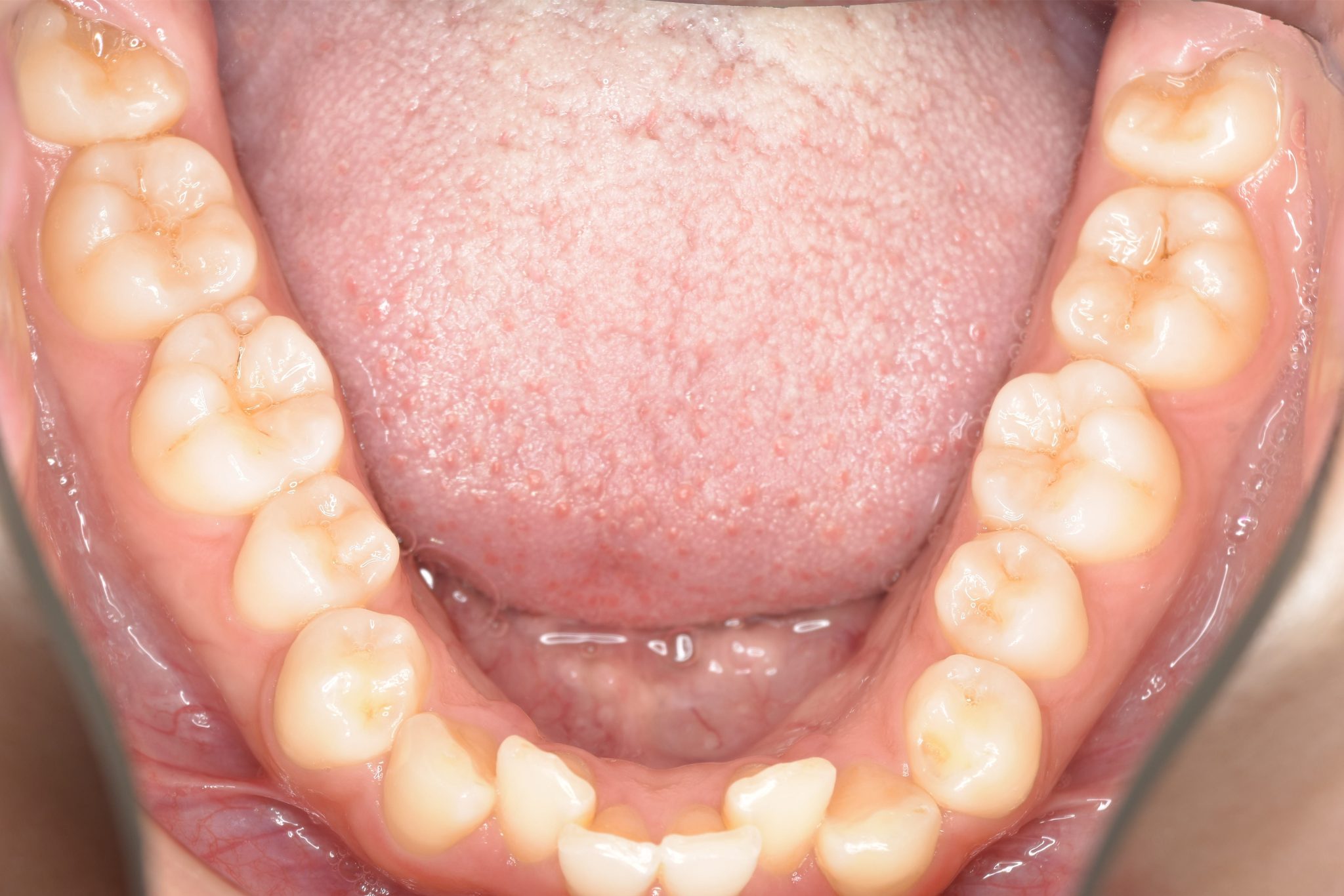 全顎ワイヤー矯正　症例_315