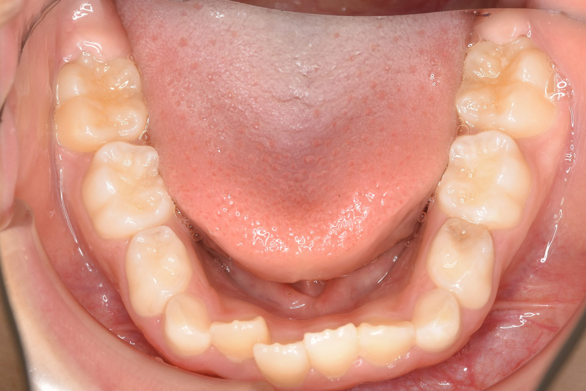 全顎ワイヤー矯正　症例_347