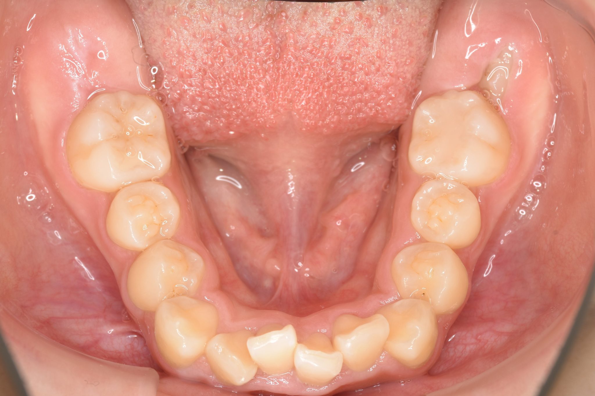 全顎ワイヤー矯正　症例_349