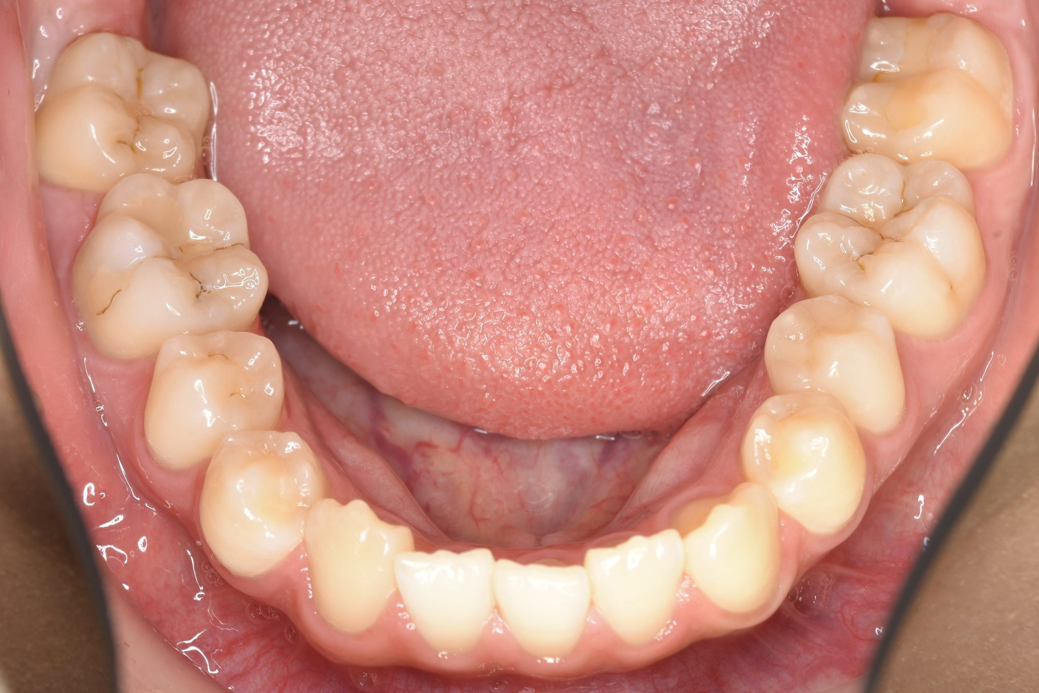 全顎ワイヤー矯正　症例_401