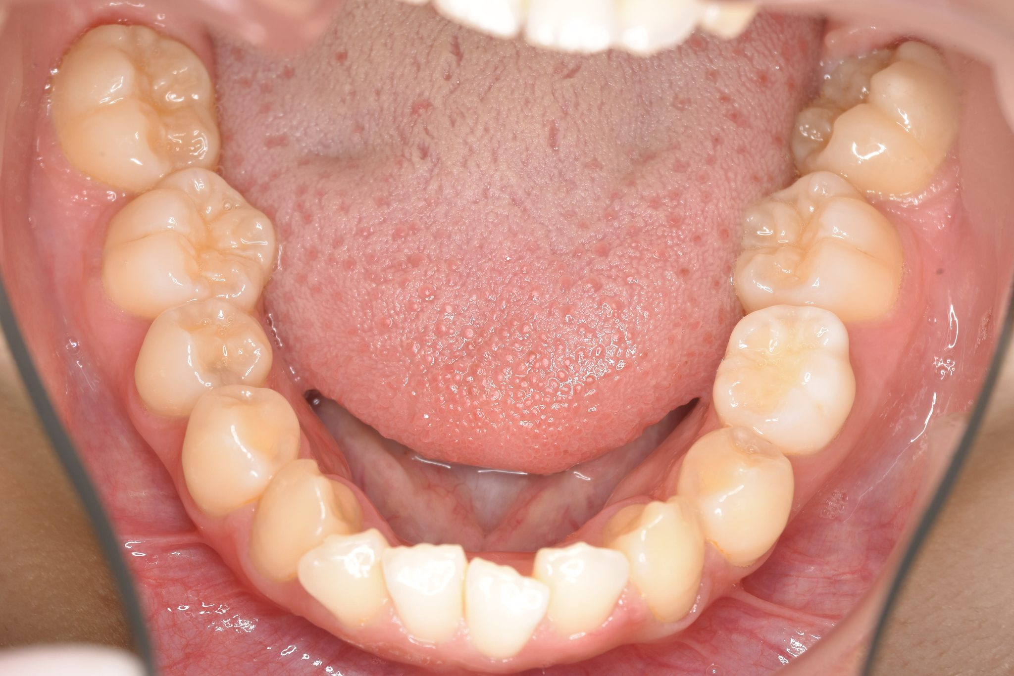 全顎ワイヤー矯正　症例_418