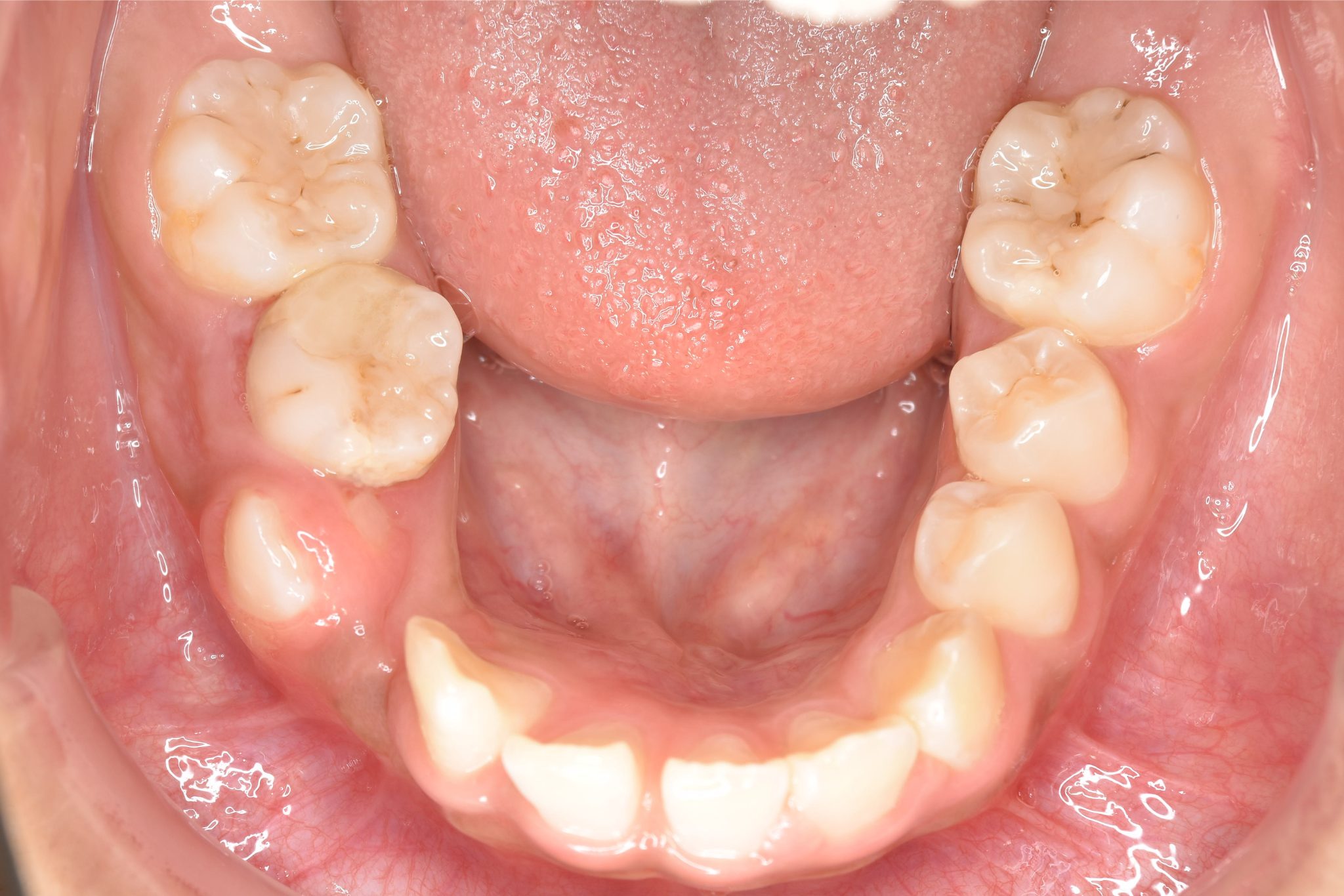 全顎ワイヤー矯正　症例_474