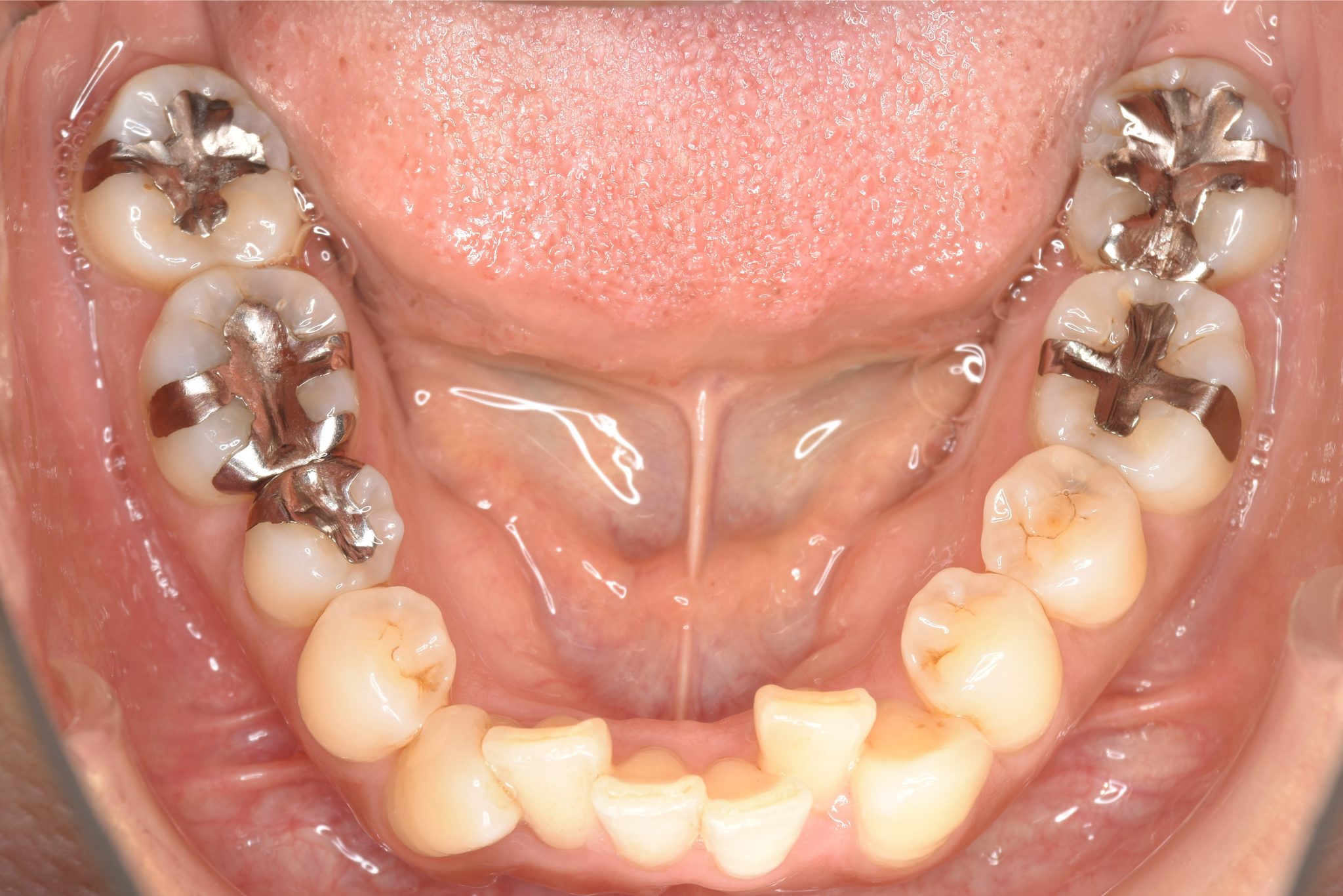 全顎ワイヤー矯正　症例_479