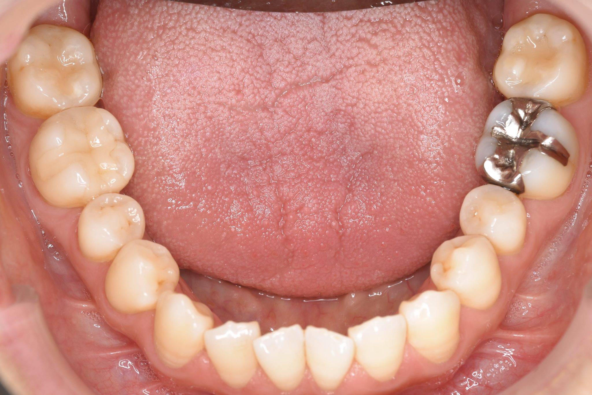 全顎ワイヤー矯正　症例_138