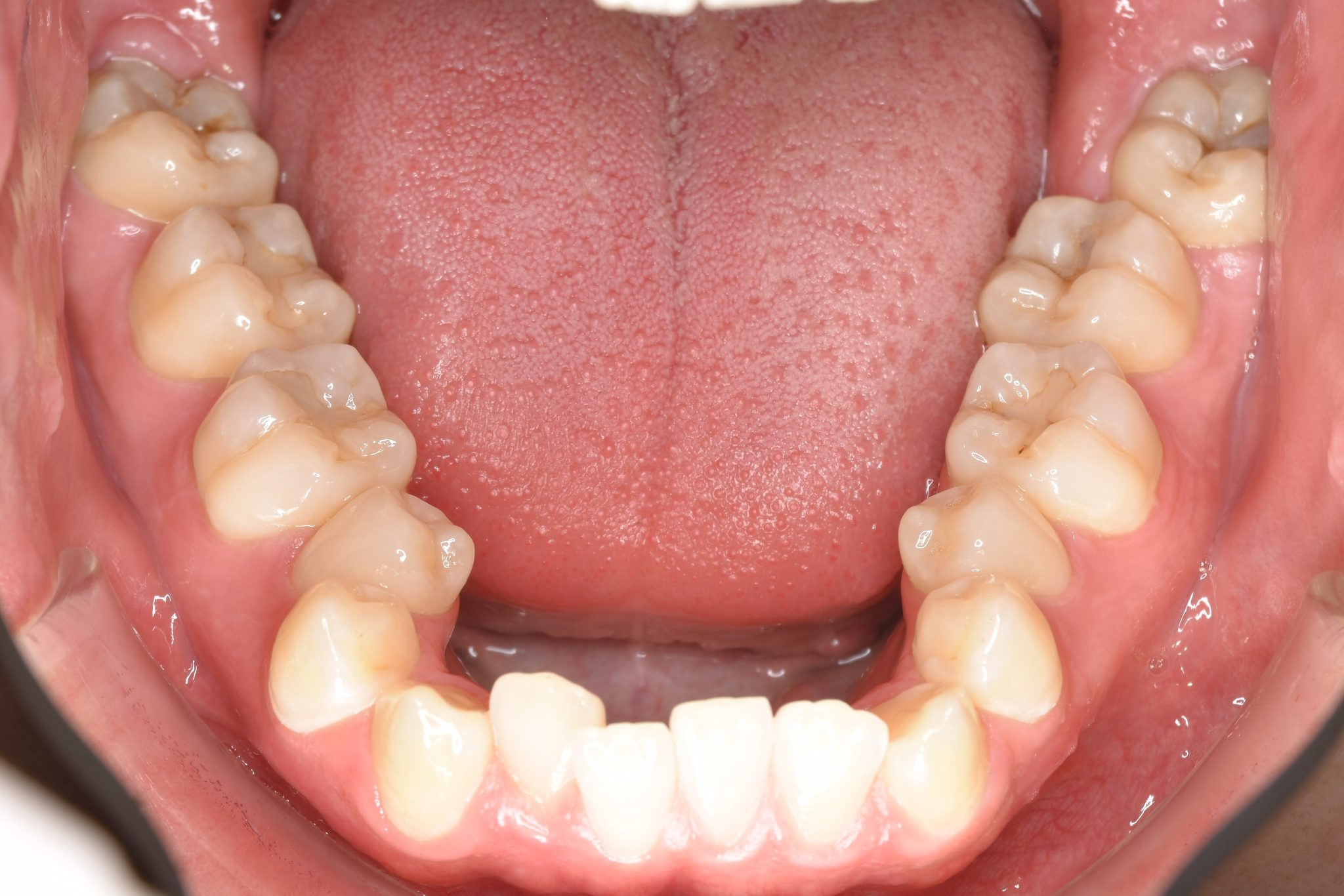 全顎ワイヤー矯正　症例_495