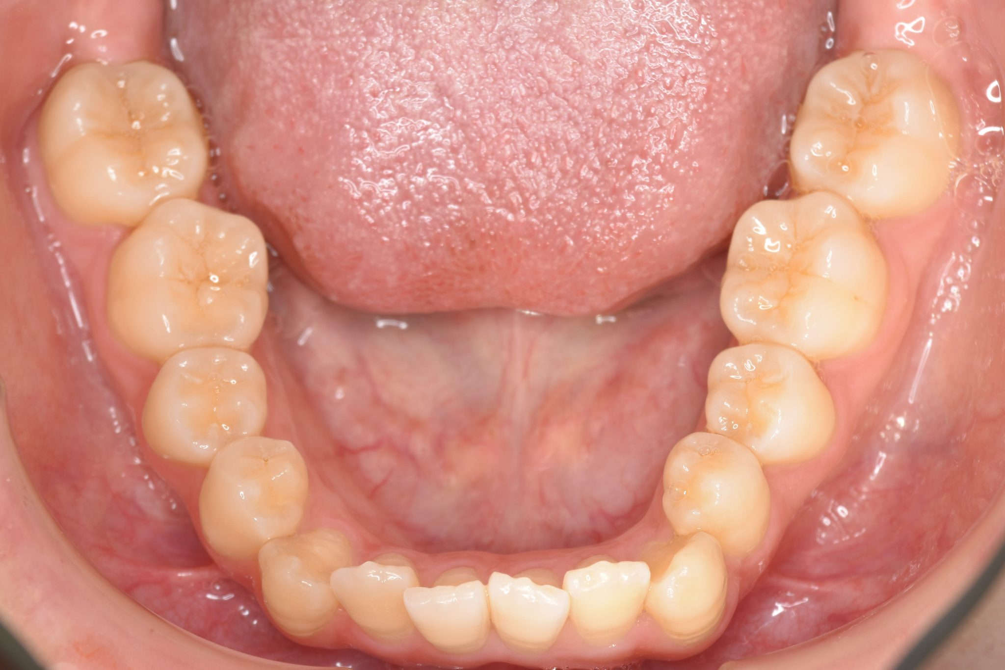 全顎ワイヤー矯正　症例_500