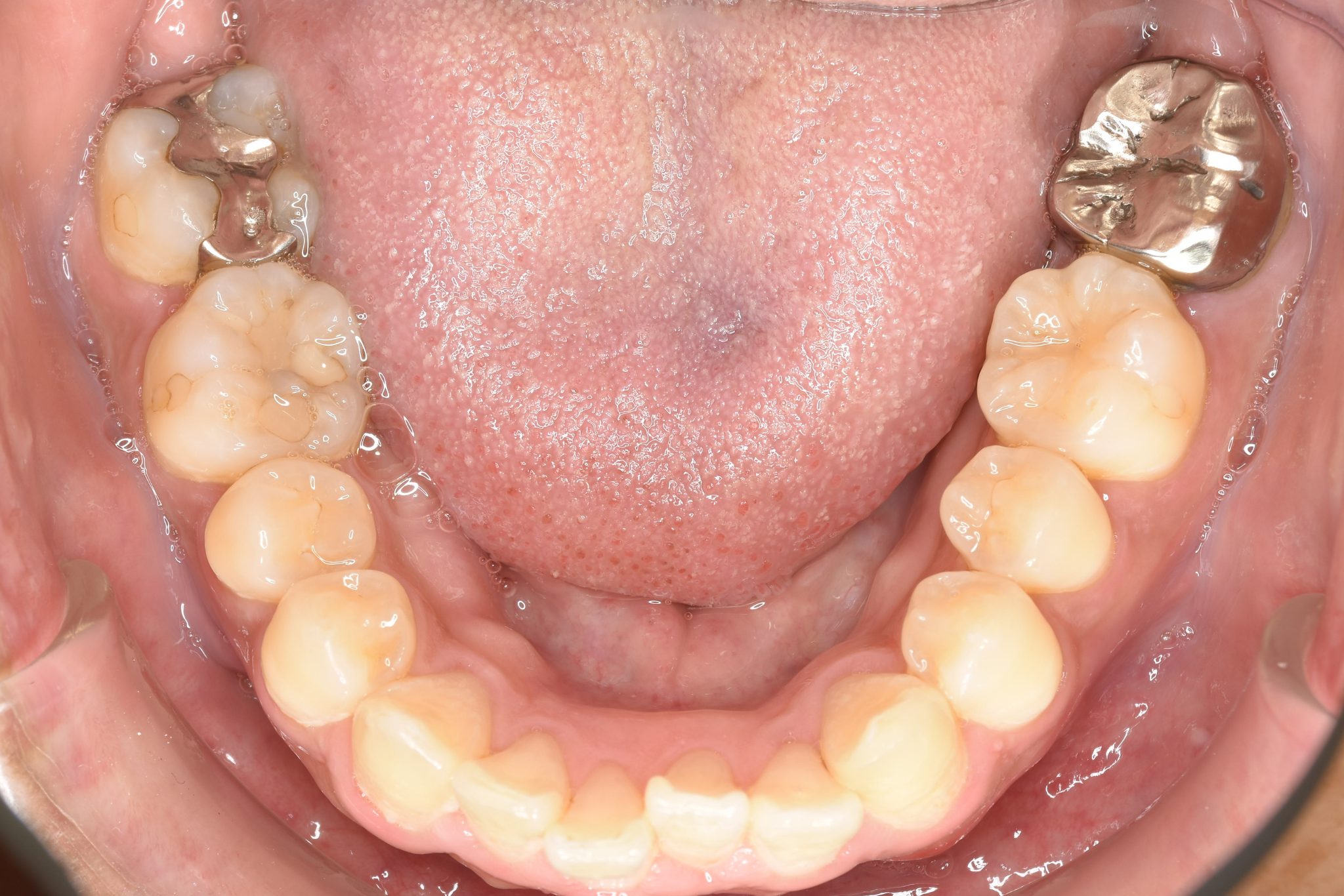 全顎ワイヤー矯正　症例_510