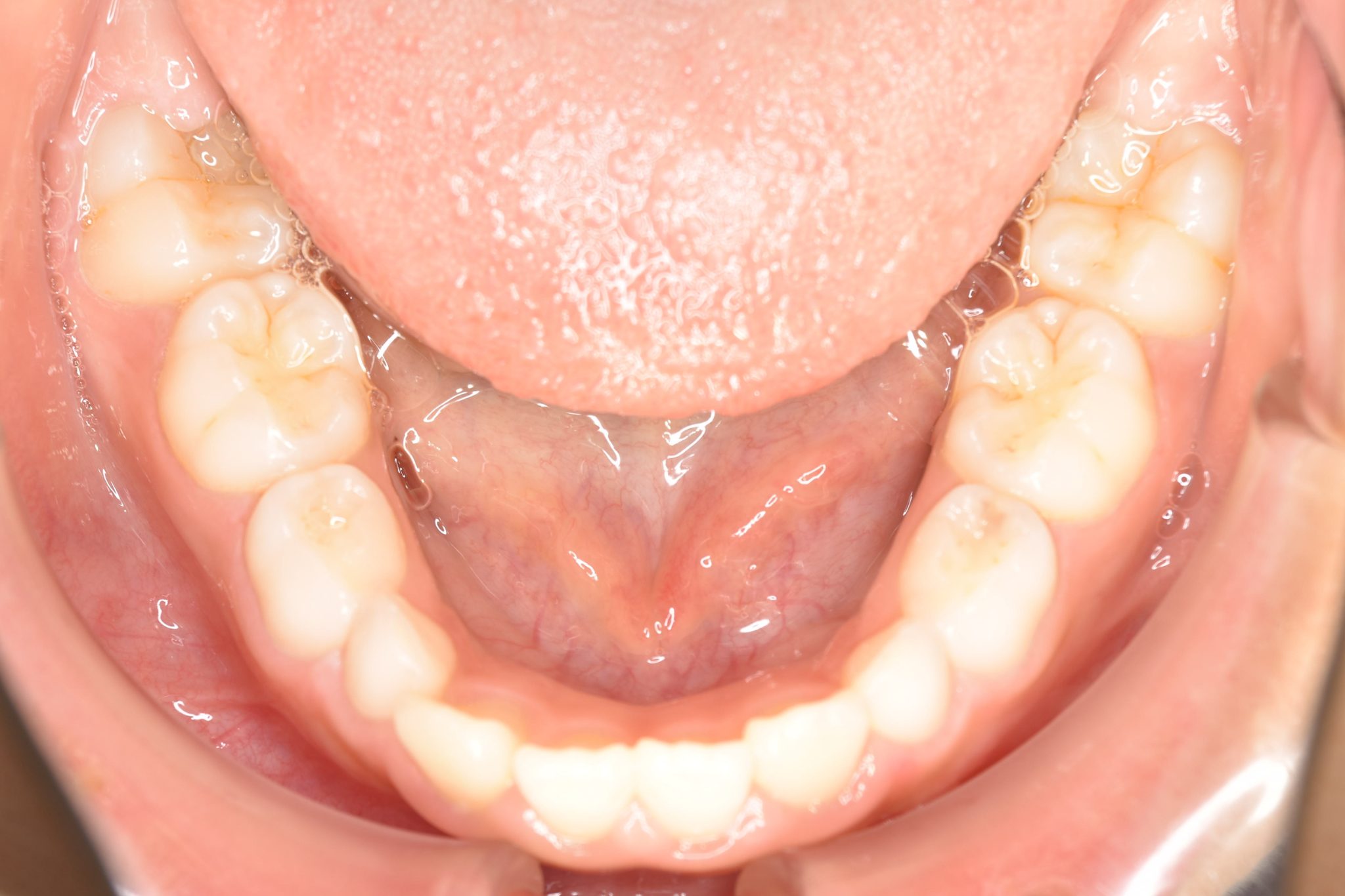 全顎ワイヤー矯正　症例_547