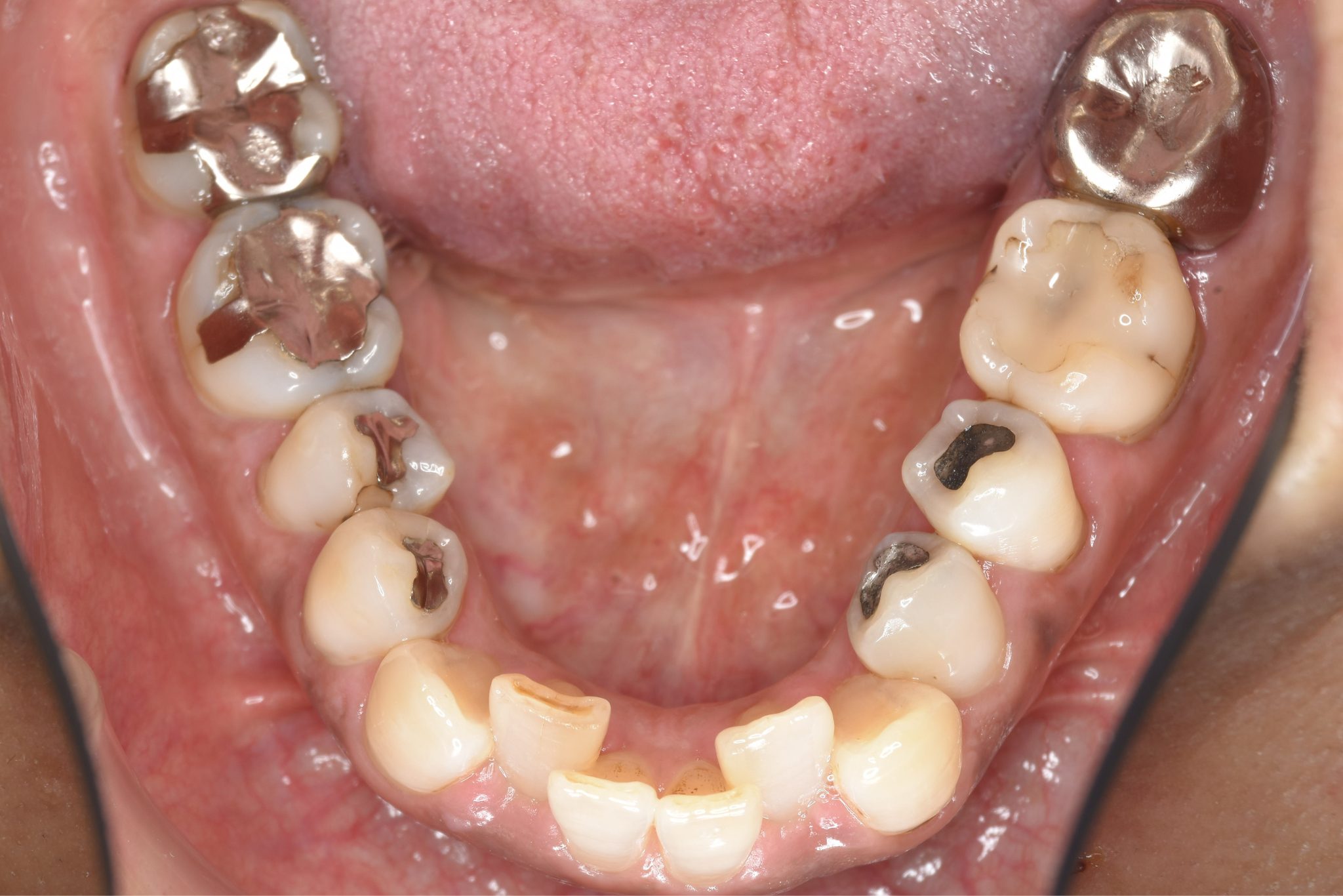 全顎ワイヤー矯正　症例_588