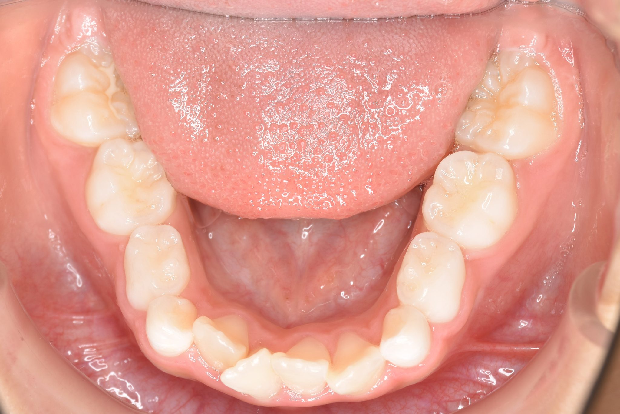 全顎ワイヤー矯正　症例_610