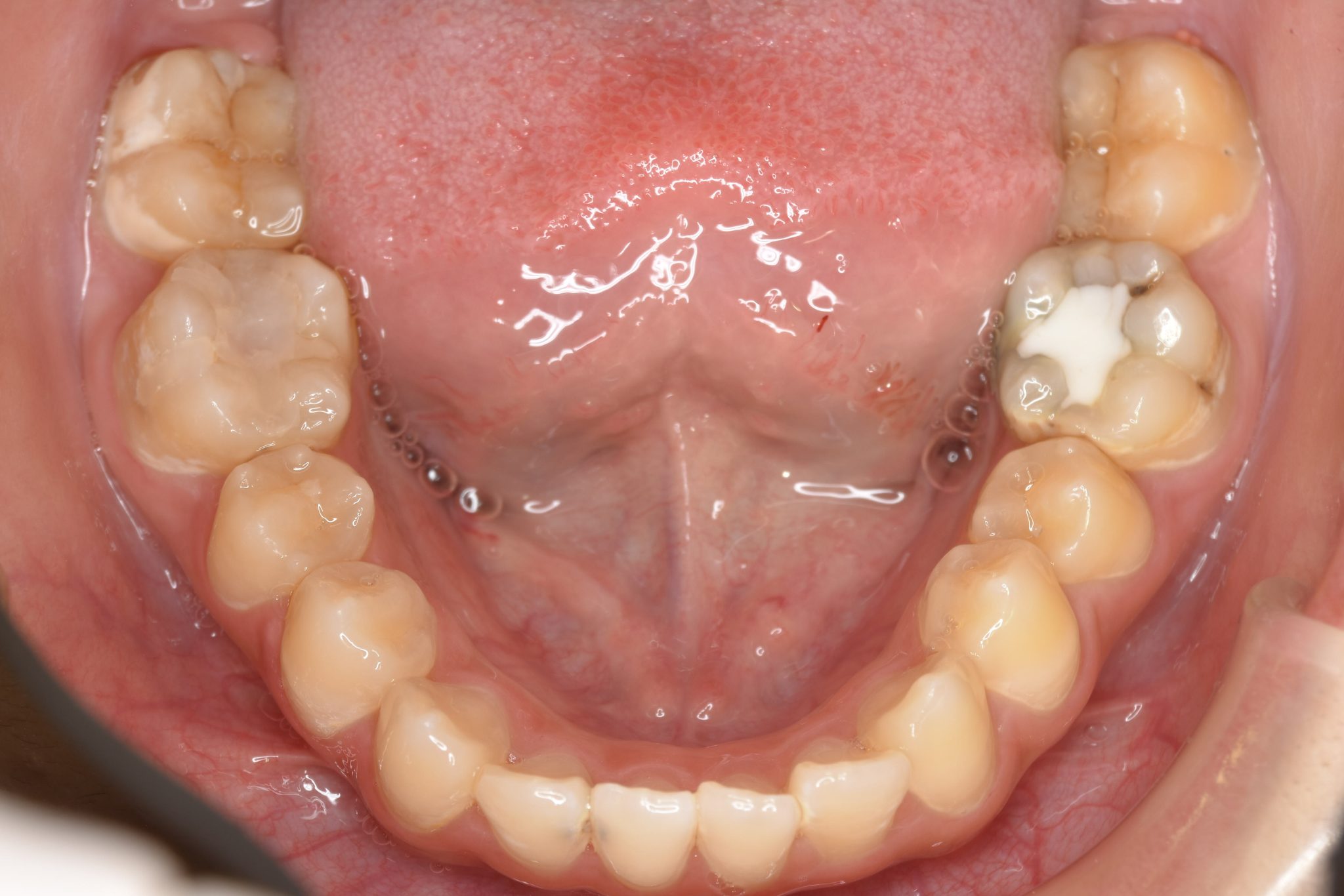 全顎ワイヤー矯正　症例_640