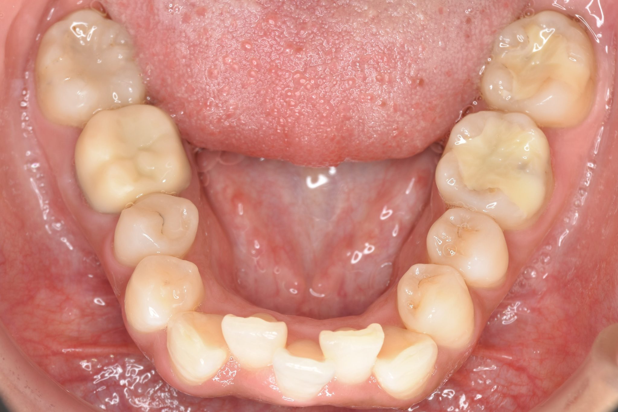 全顎ワイヤー矯正　症例_649