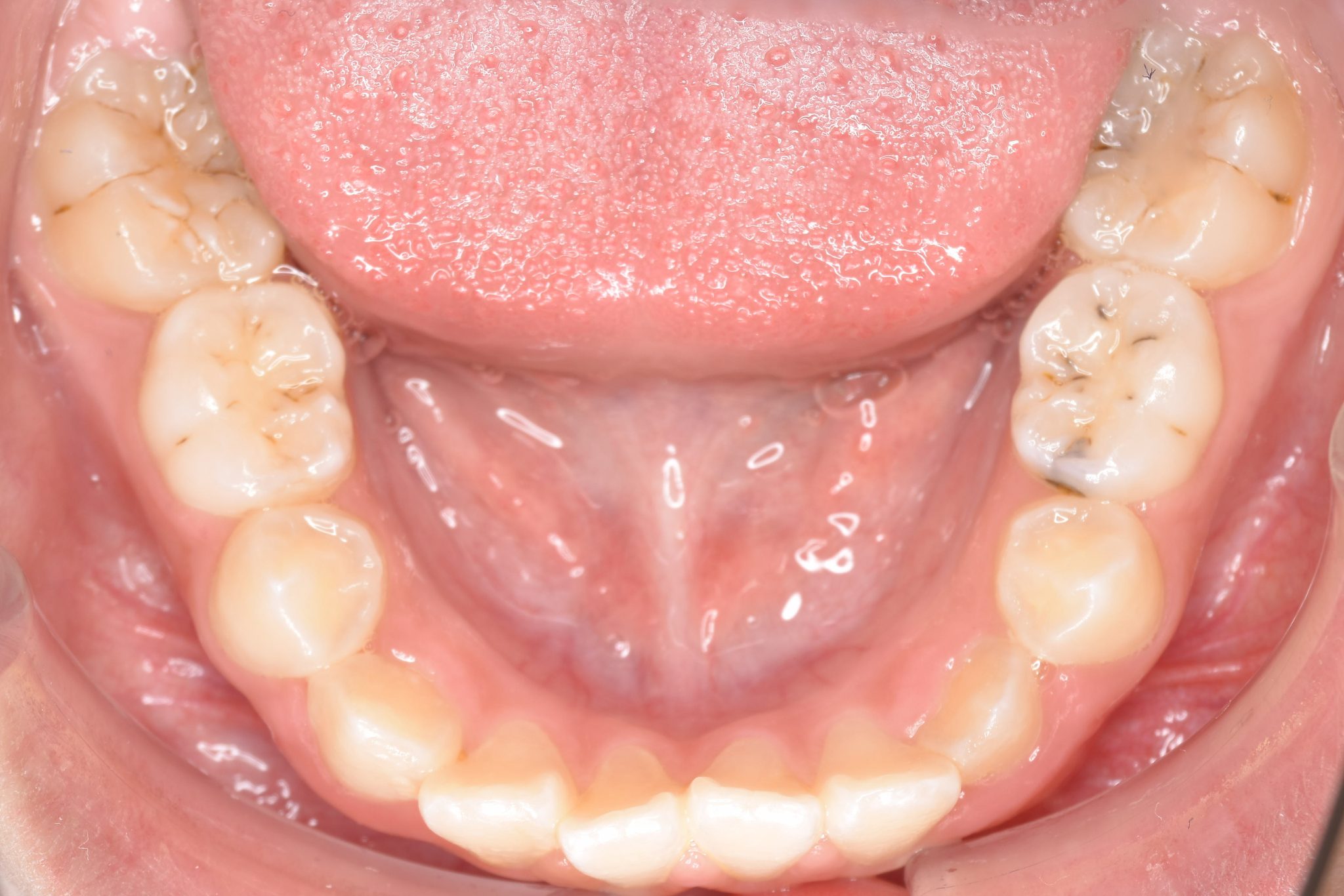 全顎ワイヤー矯正　症例_139