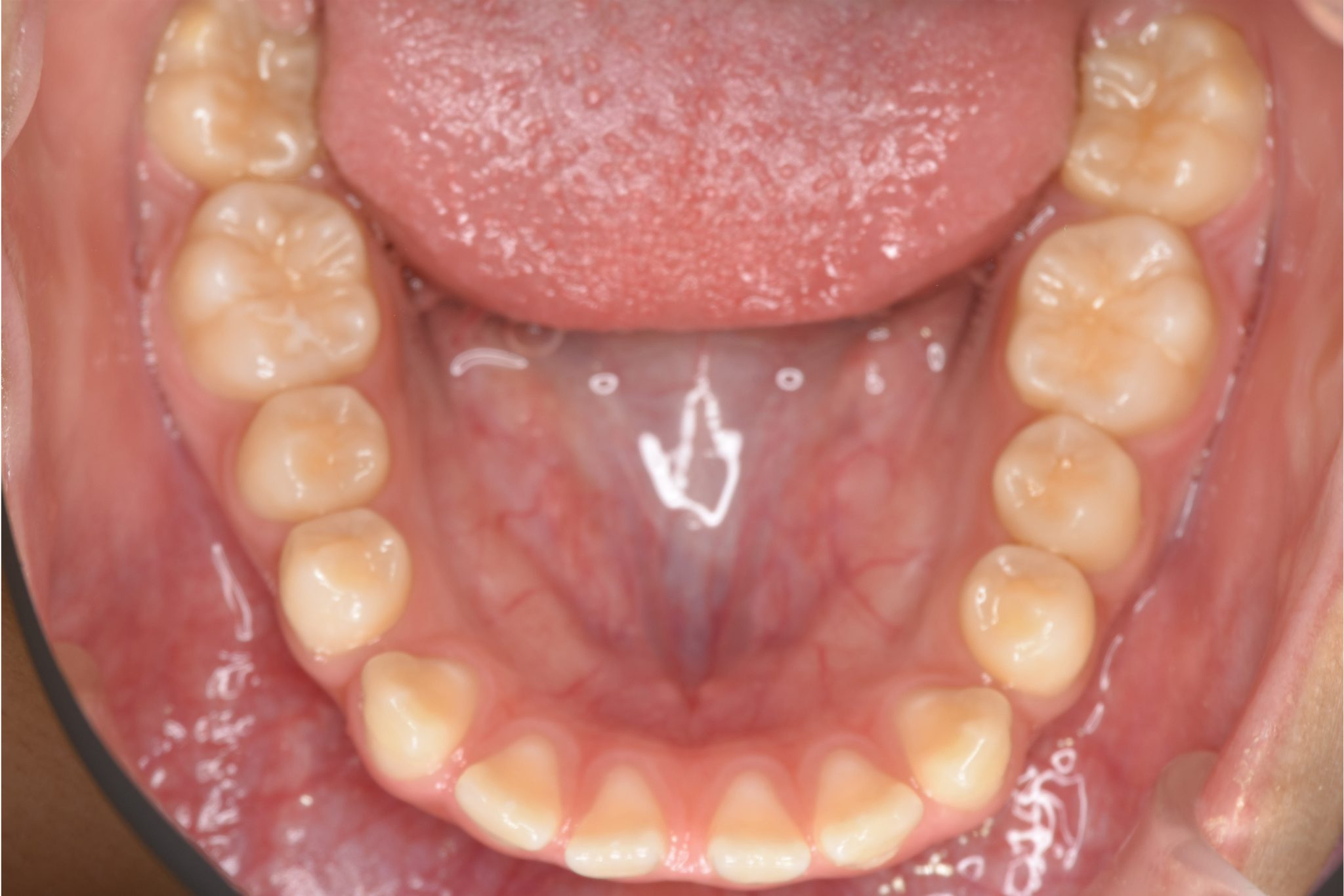 全顎ワイヤー矯正　症例_681