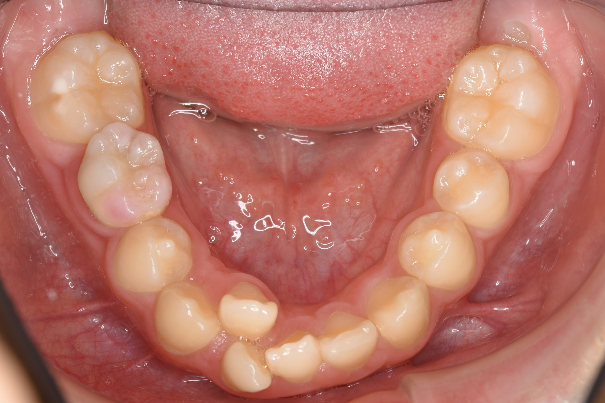 全顎ワイヤー矯正　症例_758
