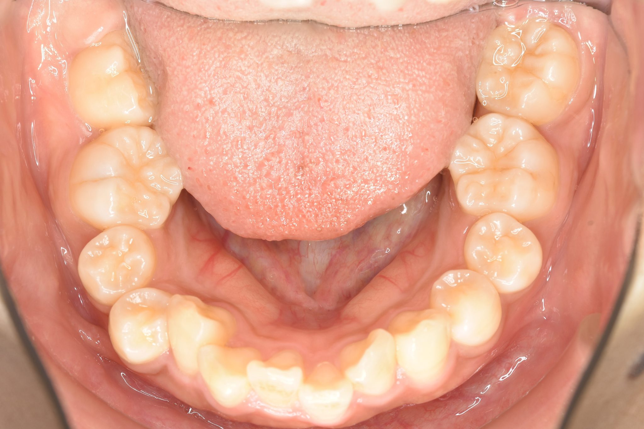 全顎ワイヤー矯正　症例_793