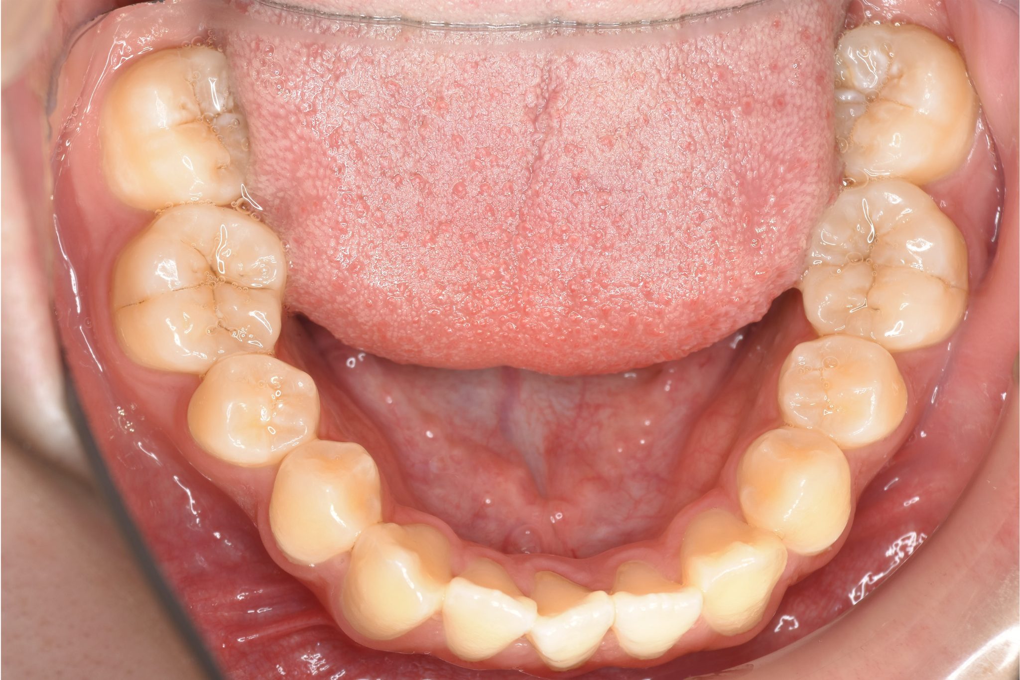 全顎ワイヤー矯正　症例_798