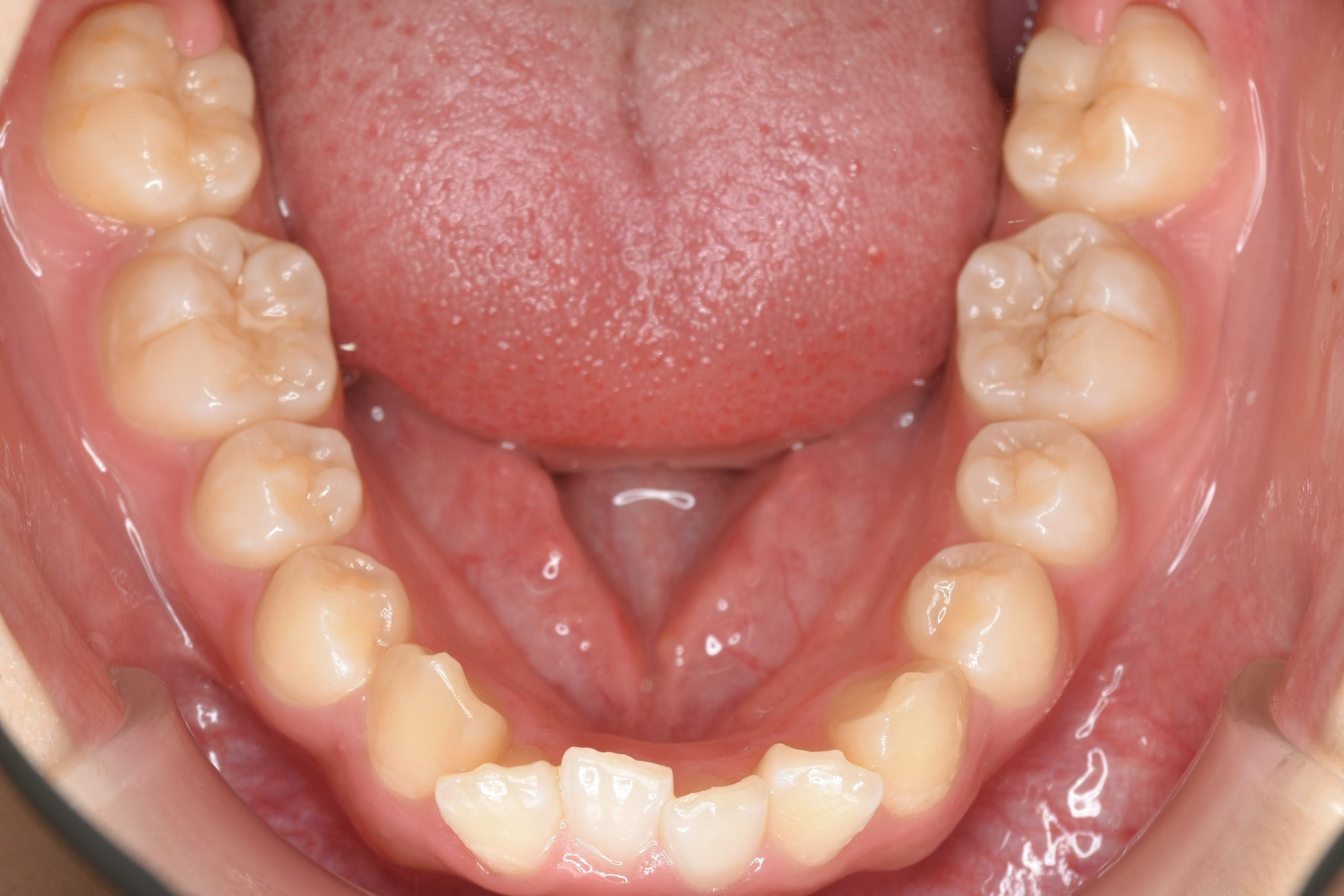 全顎ワイヤー矯正　症例_805