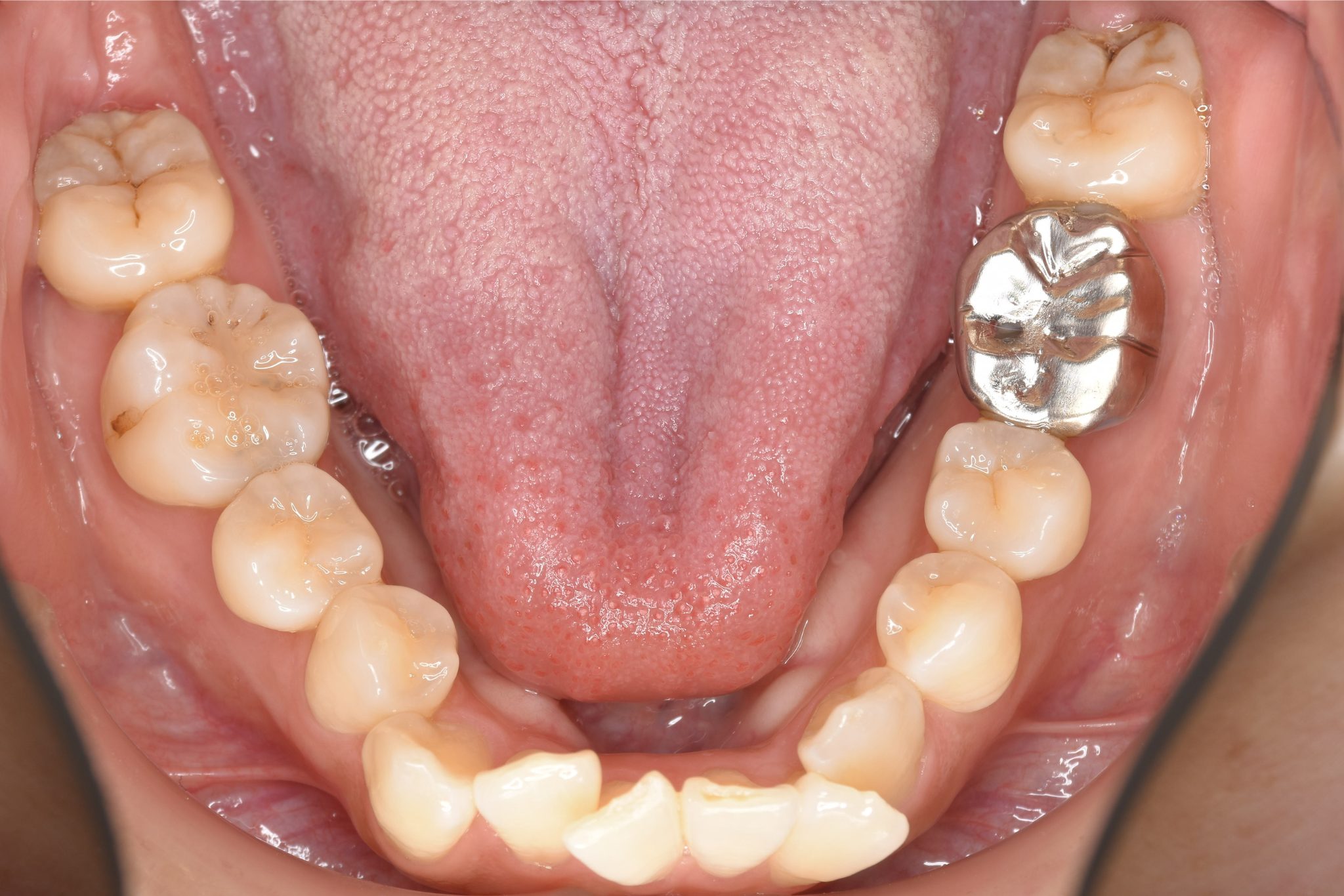 全顎ワイヤー矯正　症例_814