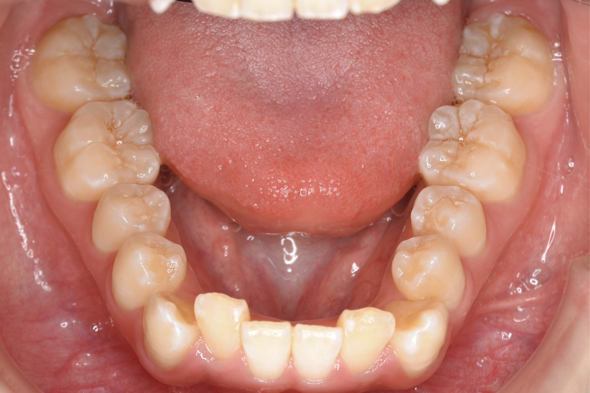 全顎ワイヤー矯正　症例_815