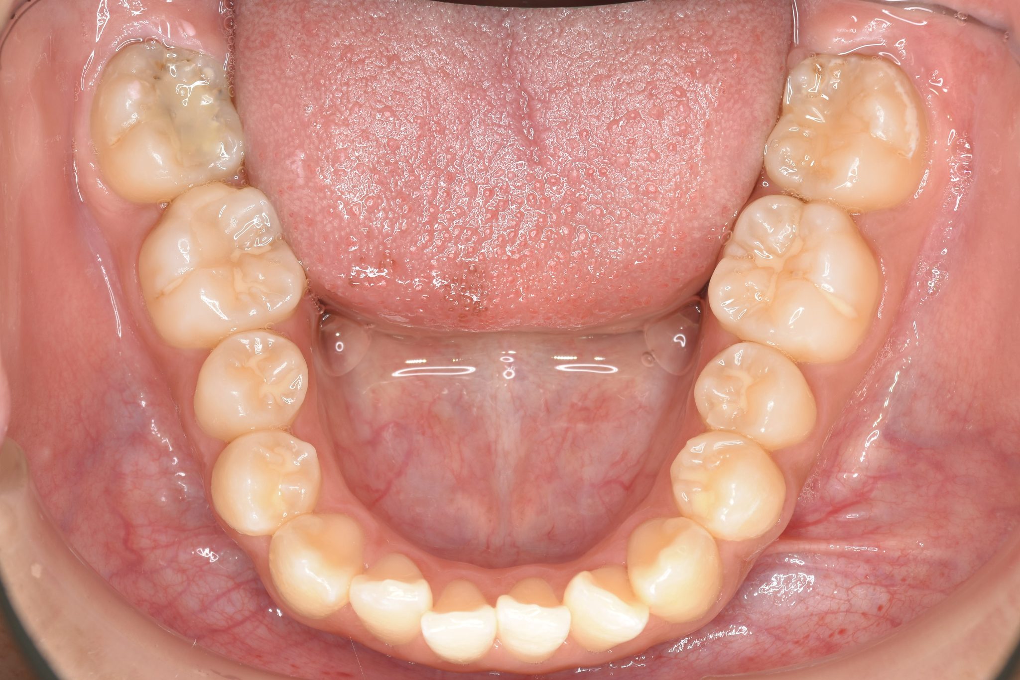 全顎ワイヤー矯正　症例_839