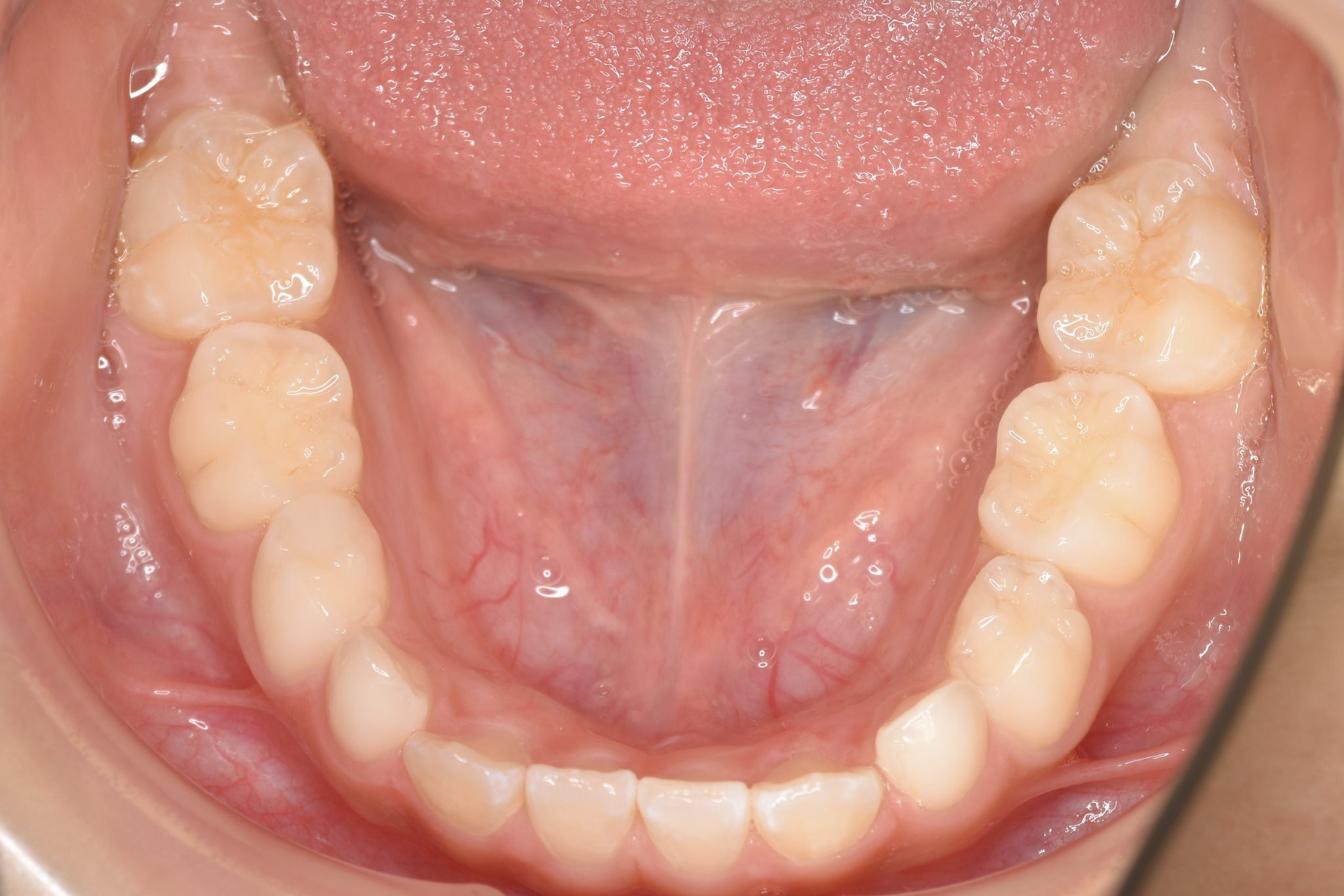 全顎ワイヤー矯正　症例_858