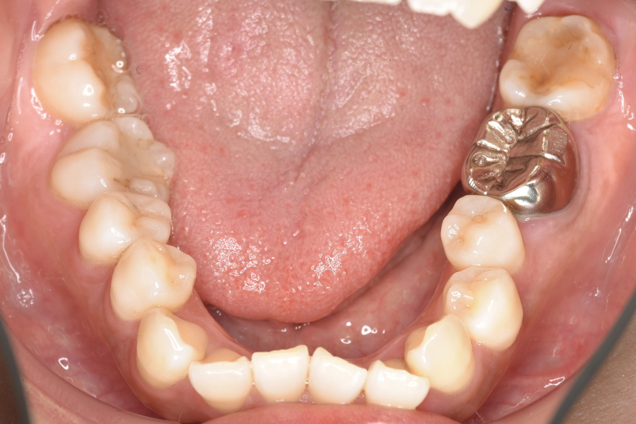 全顎ワイヤー矯正　症例_141