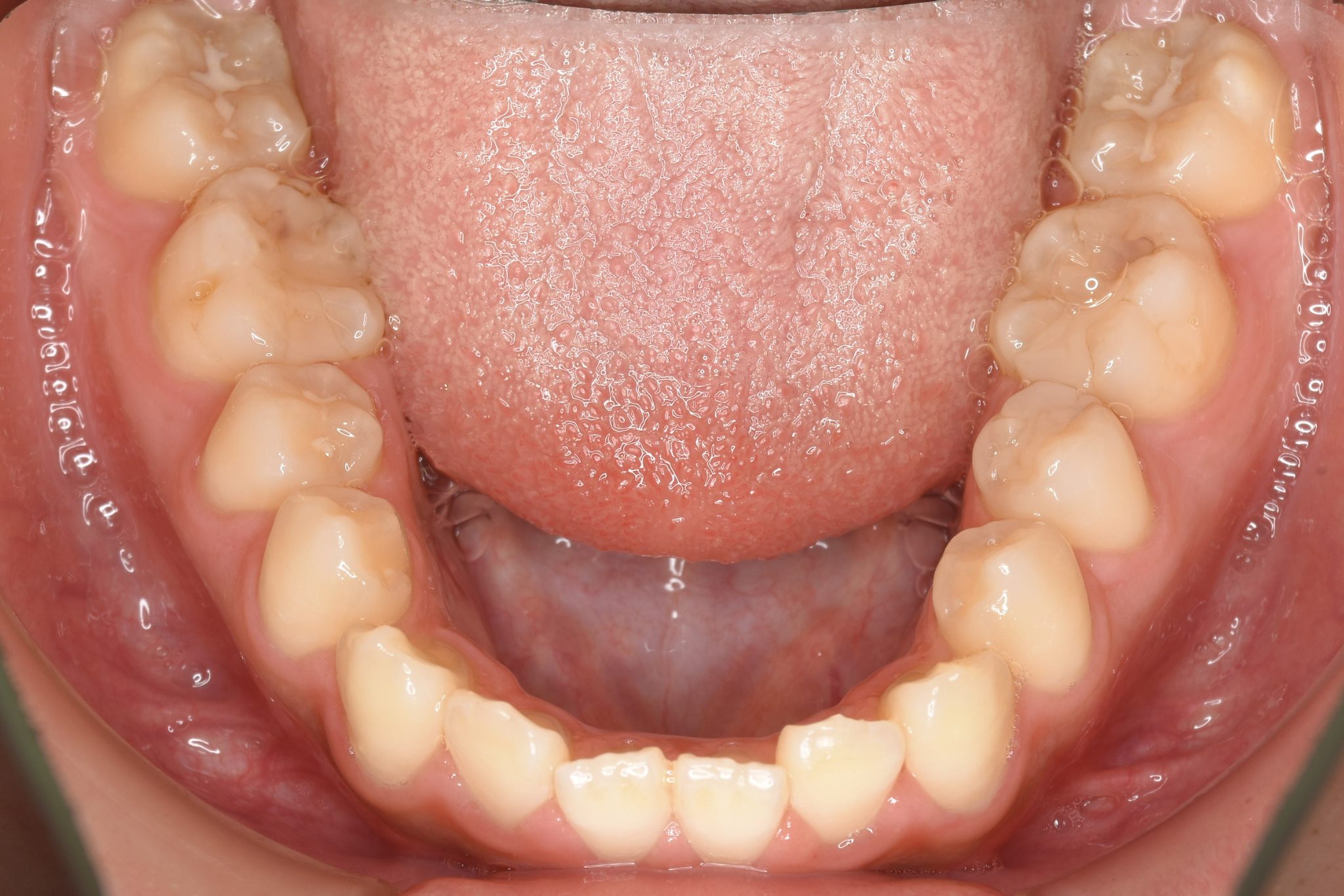 全顎ワイヤー矯正　症例_1409