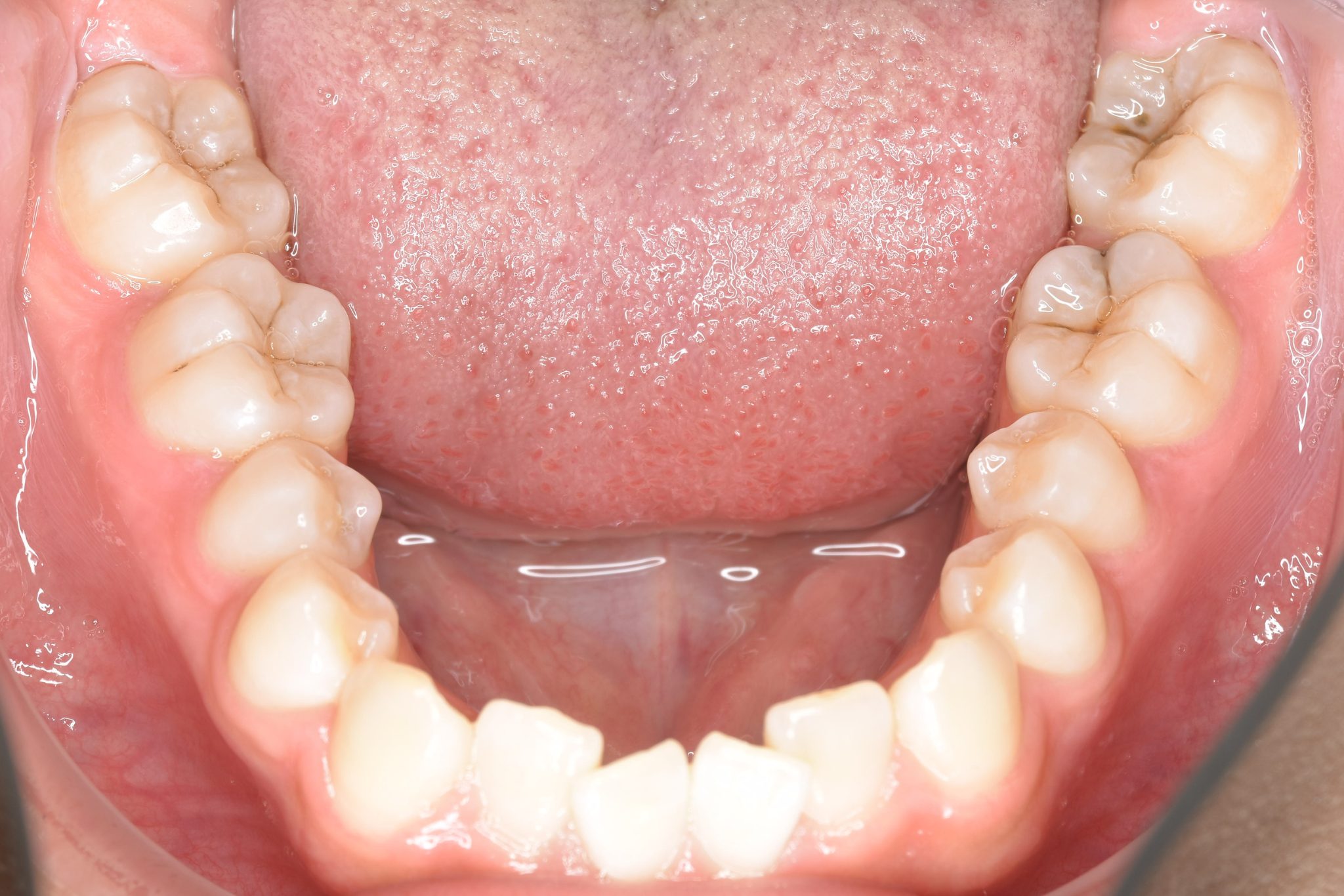 全顎ワイヤー矯正　症例_148