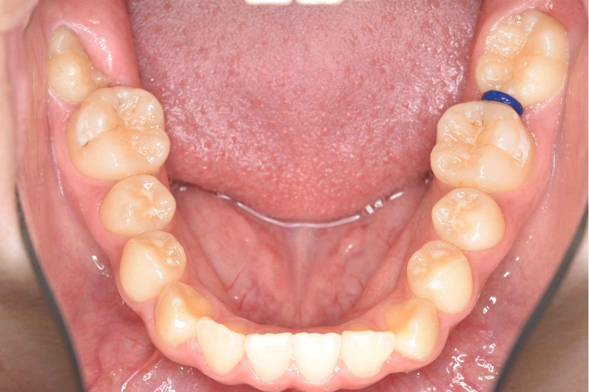 全顎ワイヤー矯正　症例_154