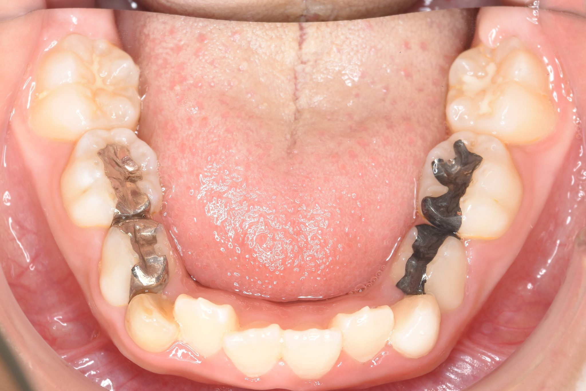 全顎ワイヤー矯正　症例_169