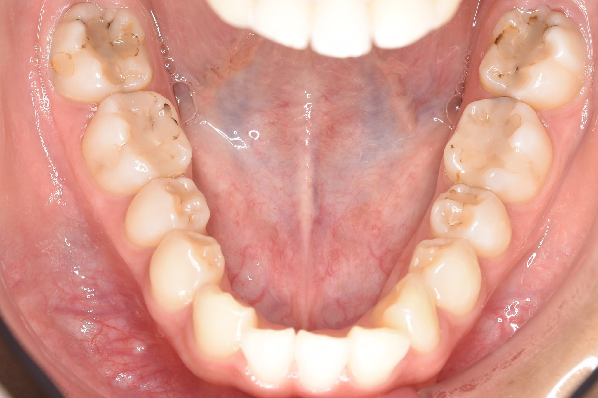 全顎ワイヤー矯正　症例_182