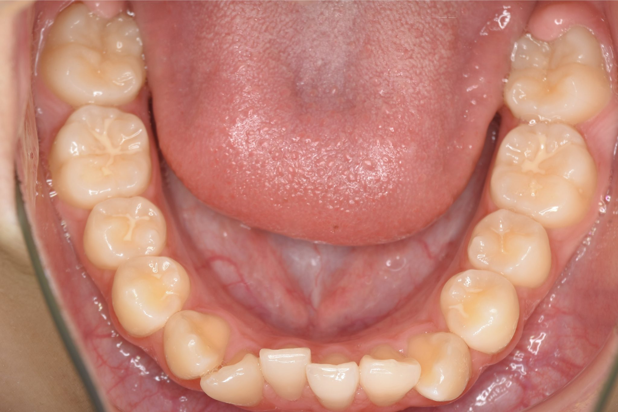 全顎ワイヤー矯正　症例_68