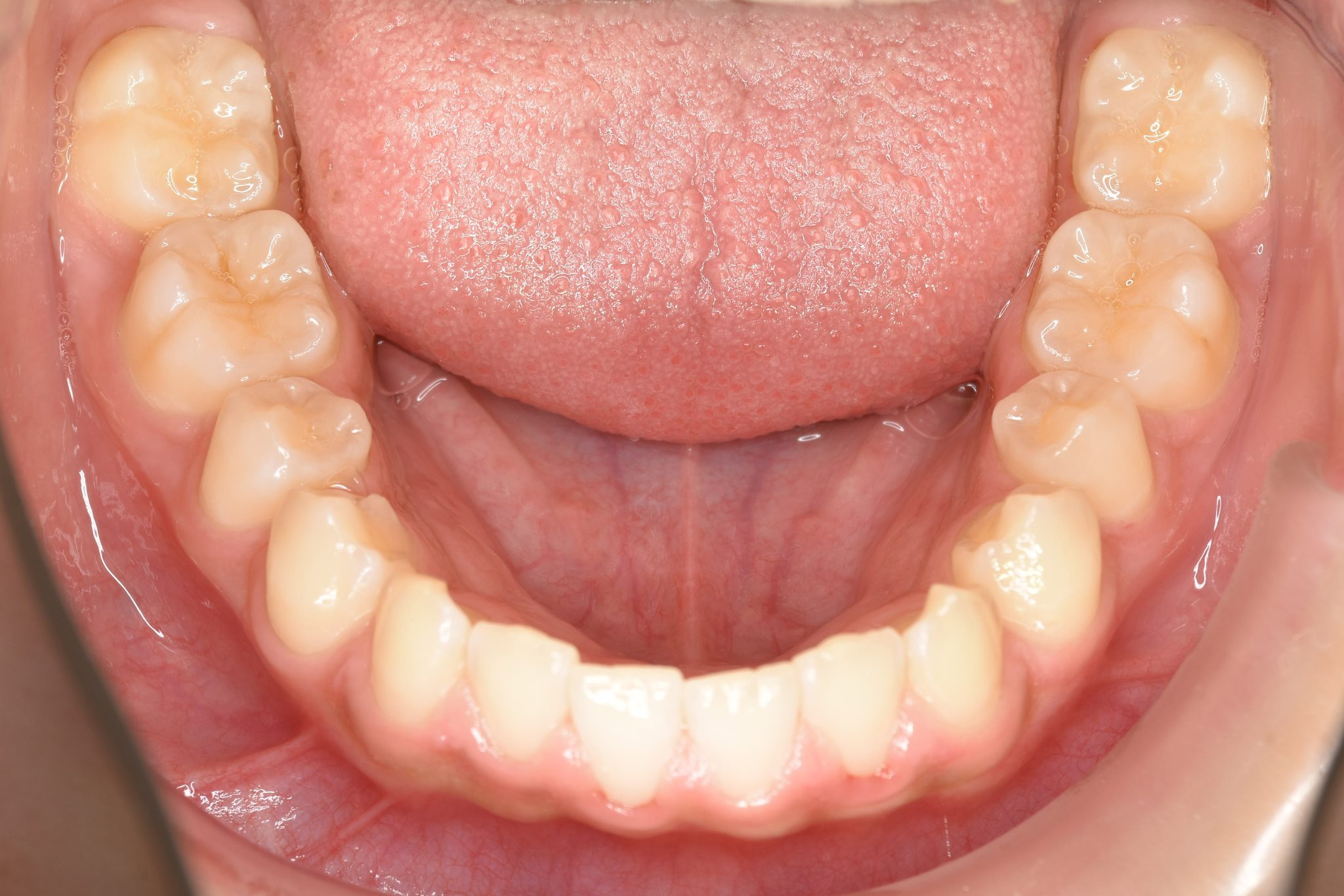 全顎ワイヤー矯正　症例_108