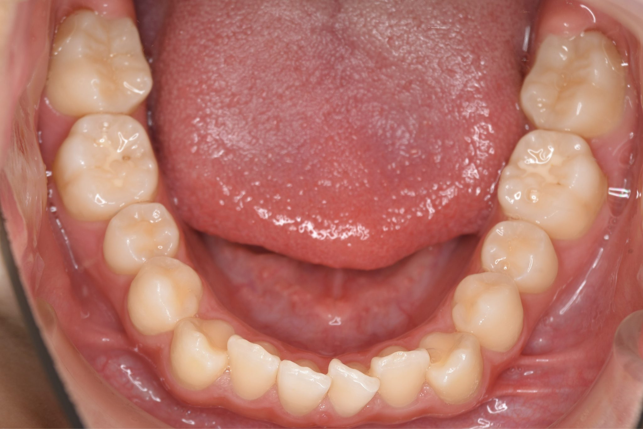 全顎ワイヤー矯正　症例_185