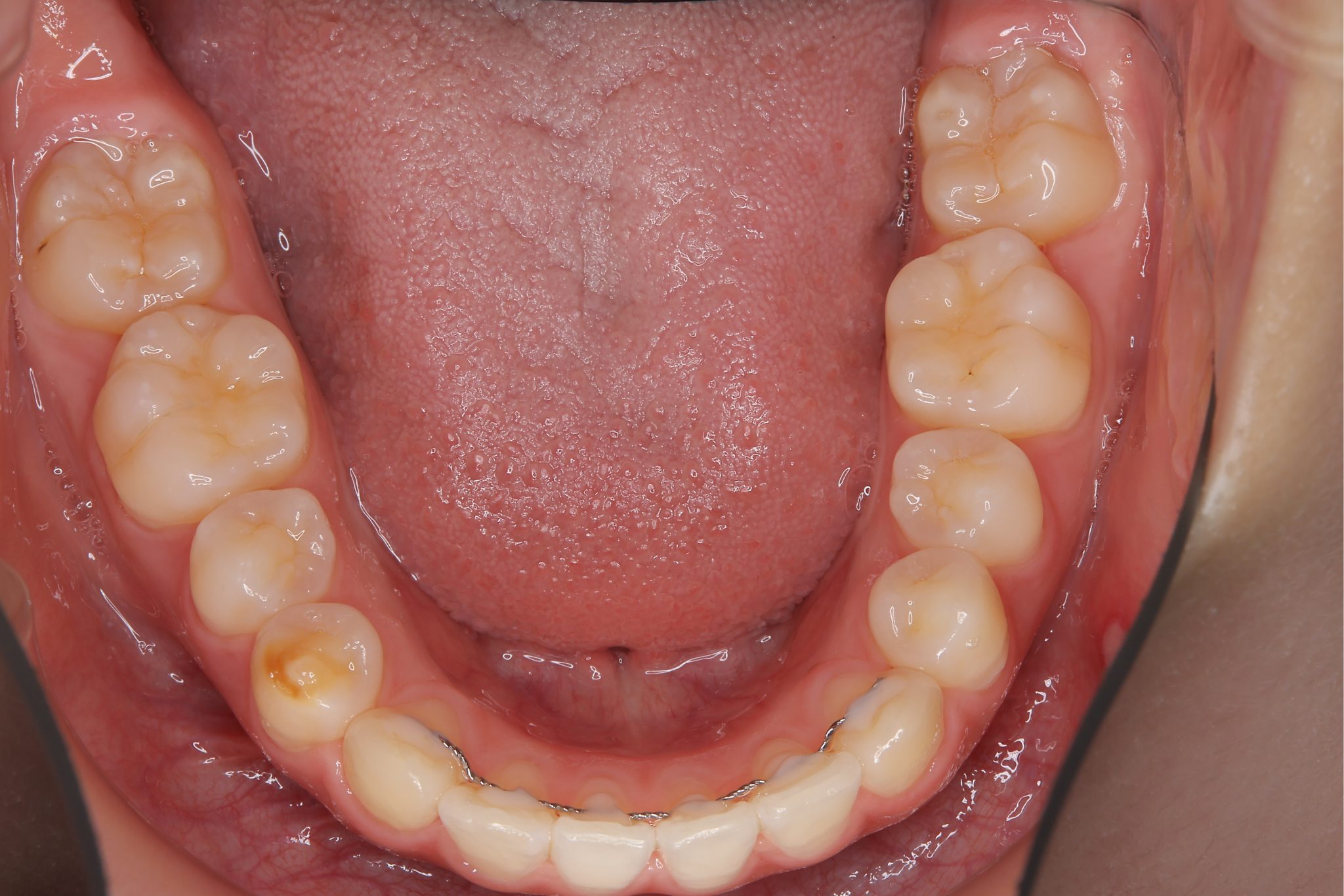 全顎ワイヤー矯正　症例_191