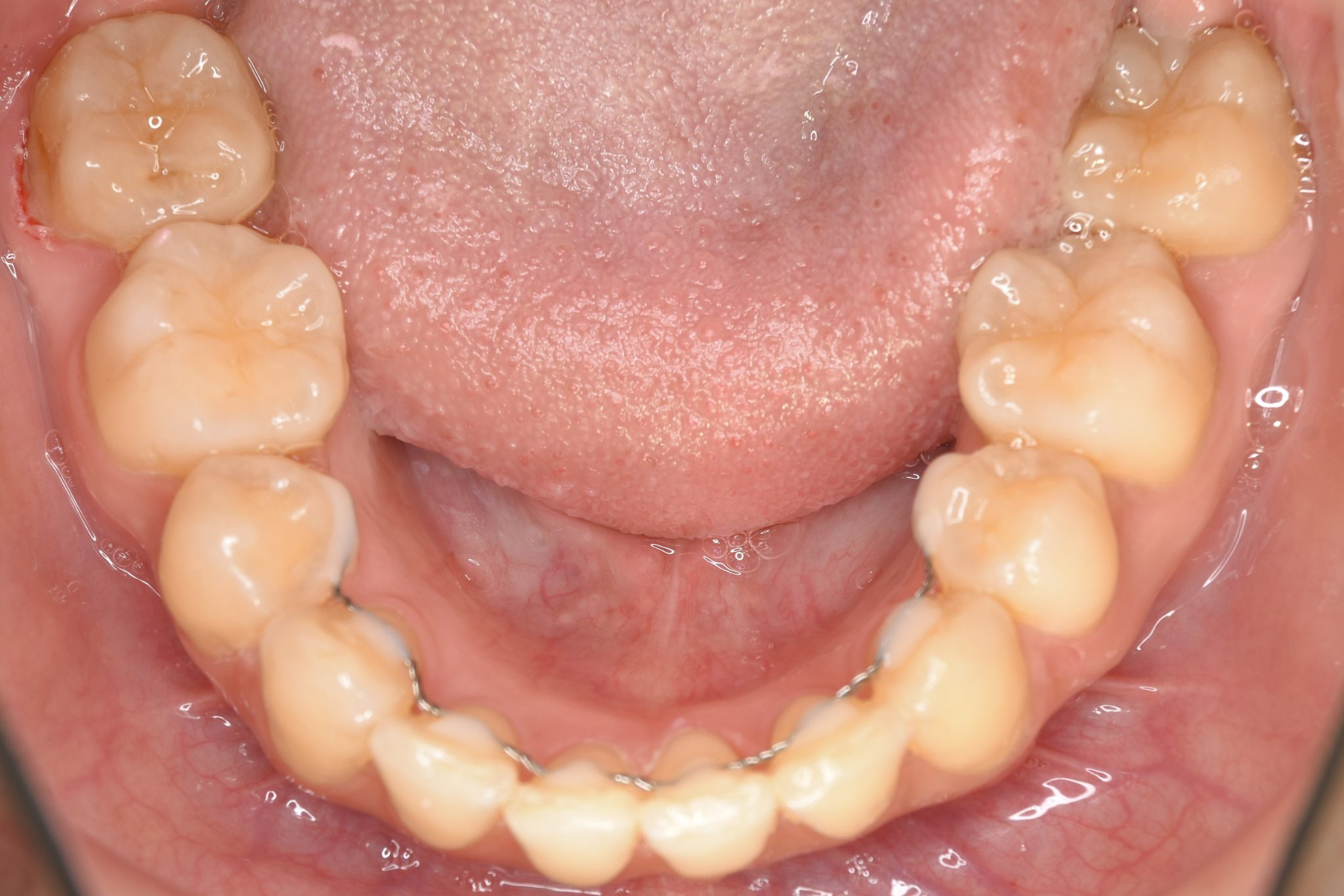 全顎ワイヤー矯正　症例_200