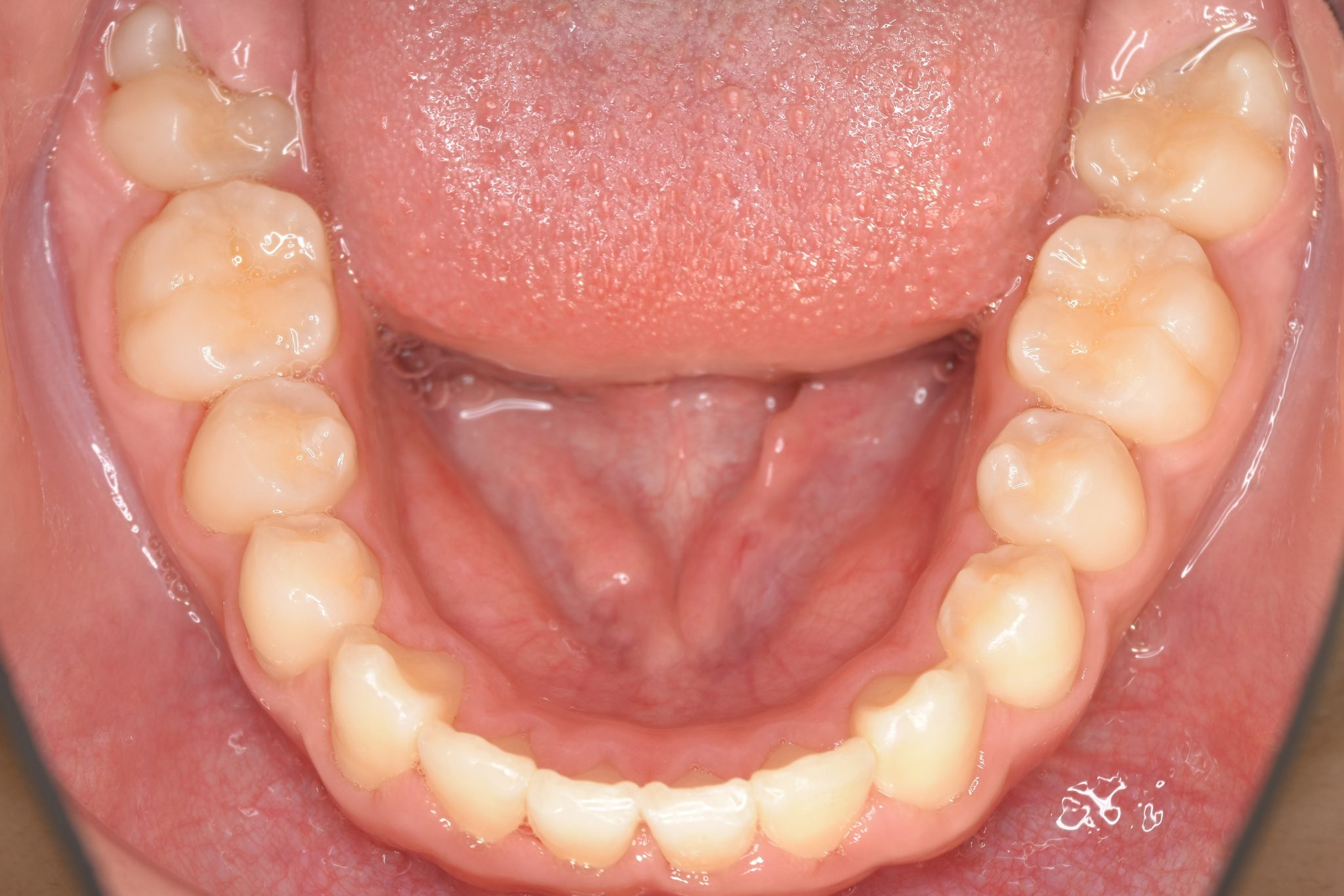 全顎ワイヤー矯正　症例_218