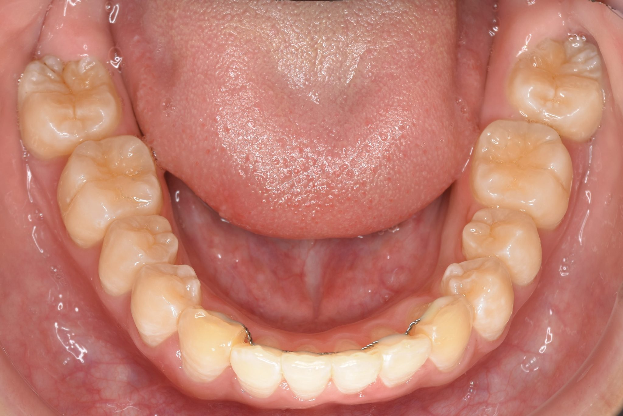 全顎ワイヤー矯正　症例_252