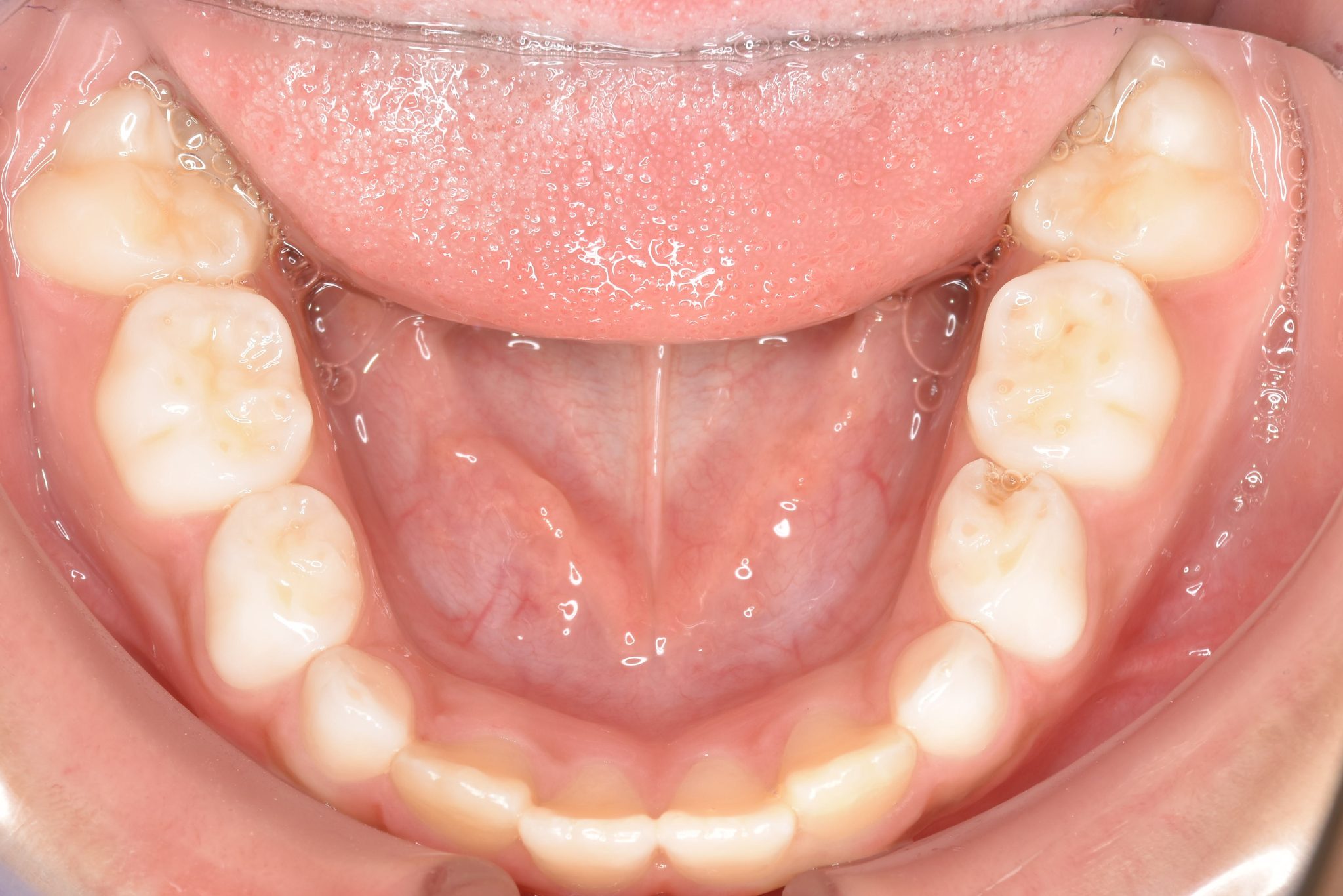 全顎ワイヤー矯正　症例_261