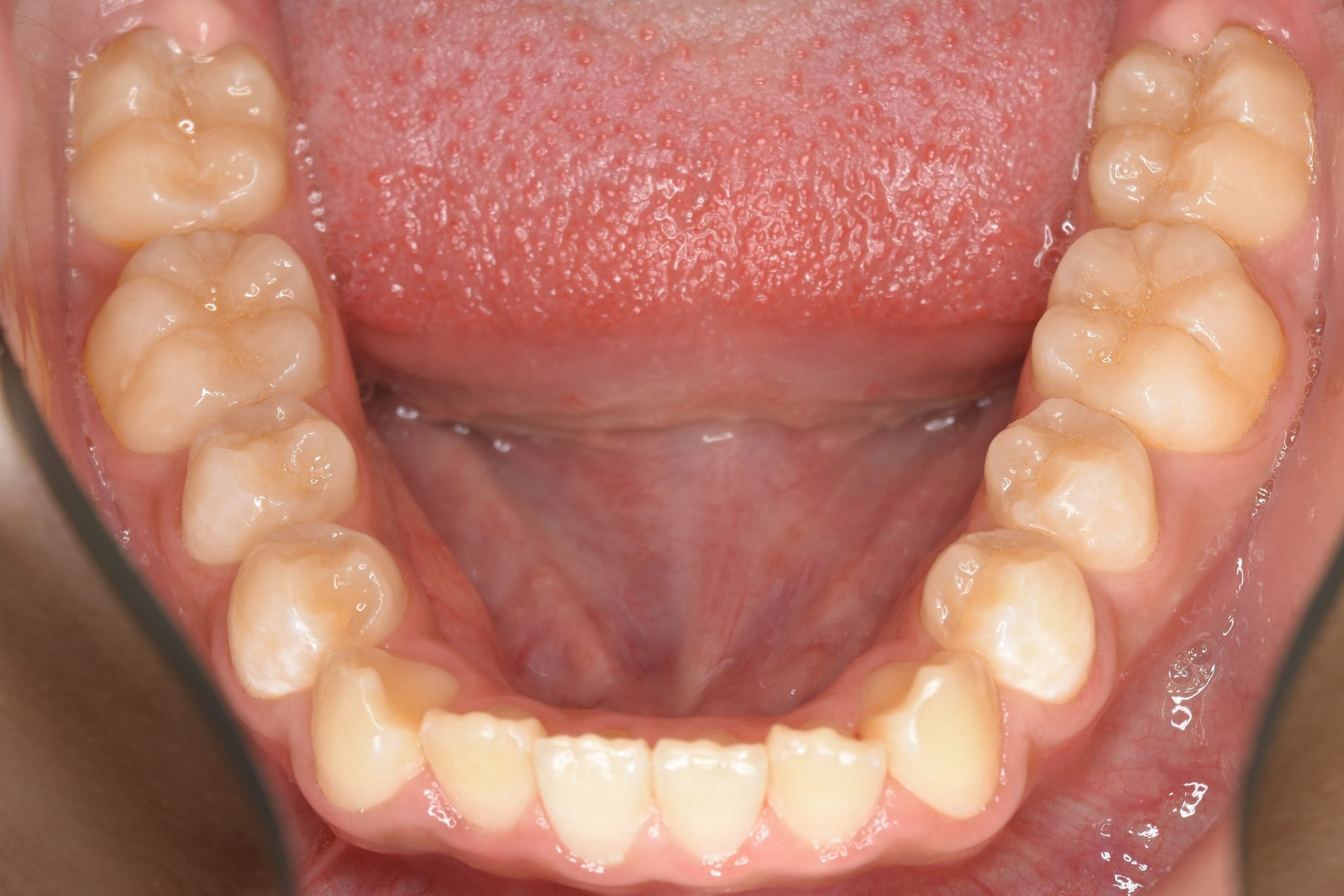 全顎ワイヤー矯正　症例_267