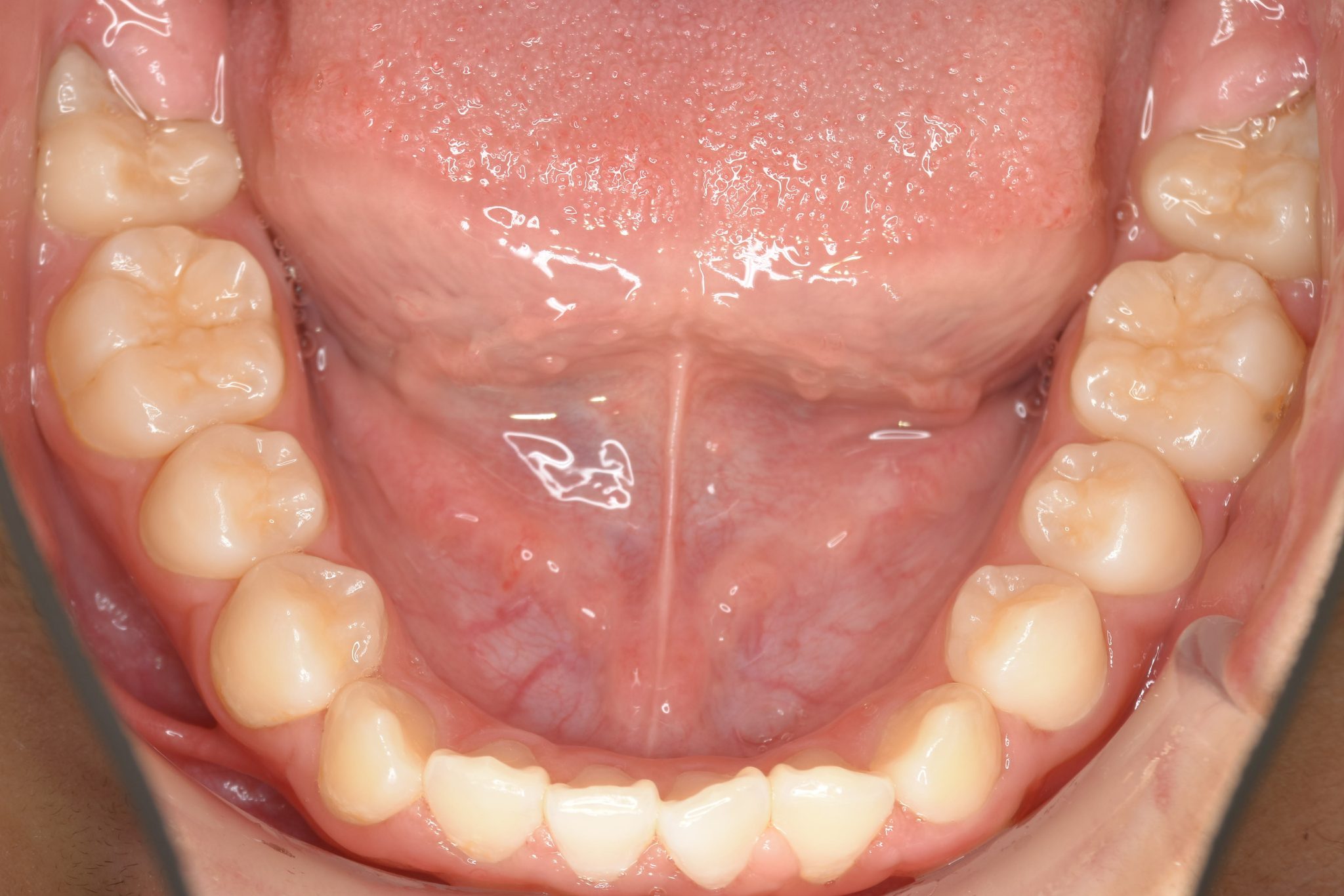 全顎ワイヤー矯正　症例_276