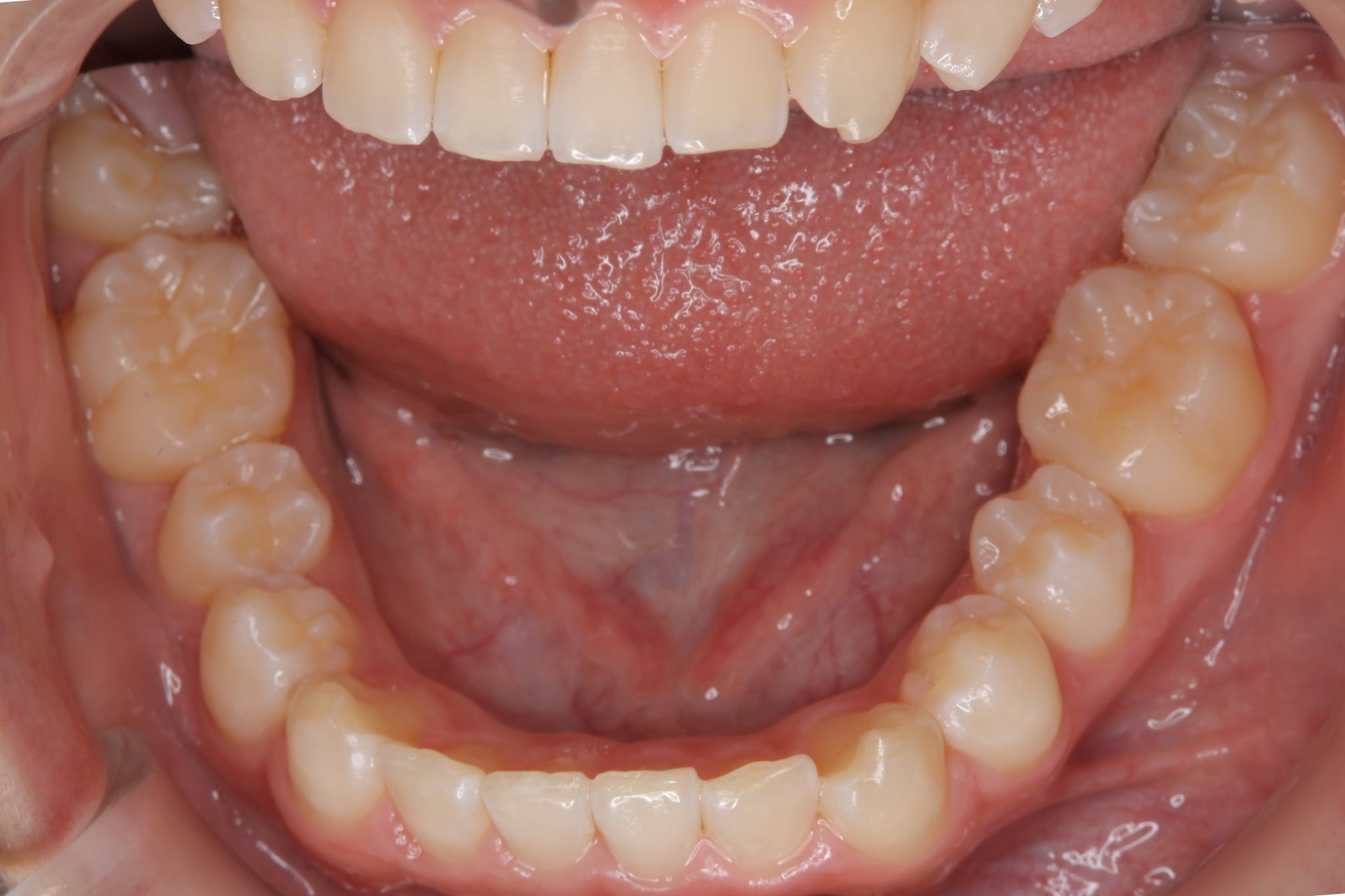 全顎ワイヤー矯正　症例_121