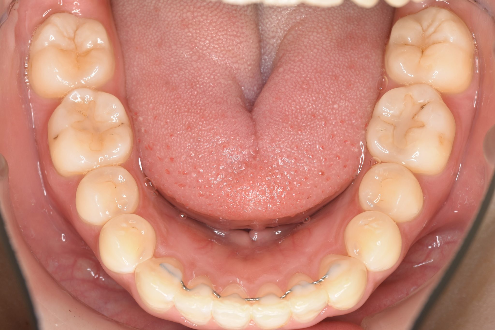 全顎ワイヤー矯正　症例_306