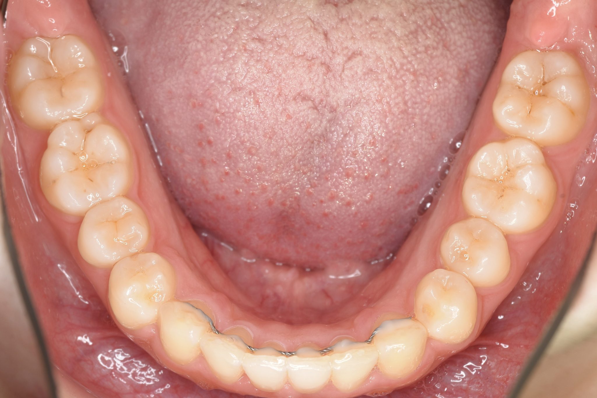 全顎ワイヤー矯正　症例_315