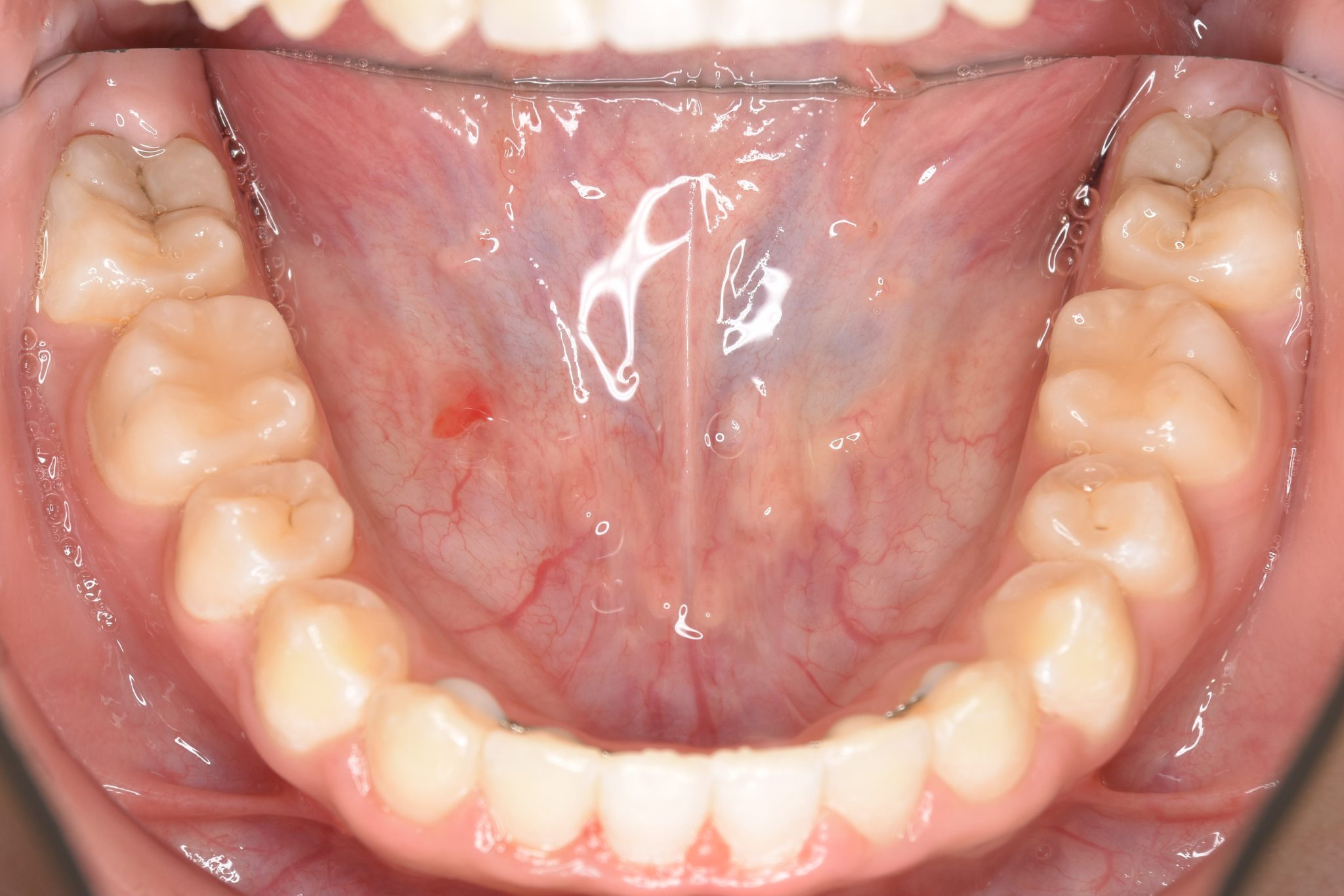 全顎ワイヤー矯正　症例_320