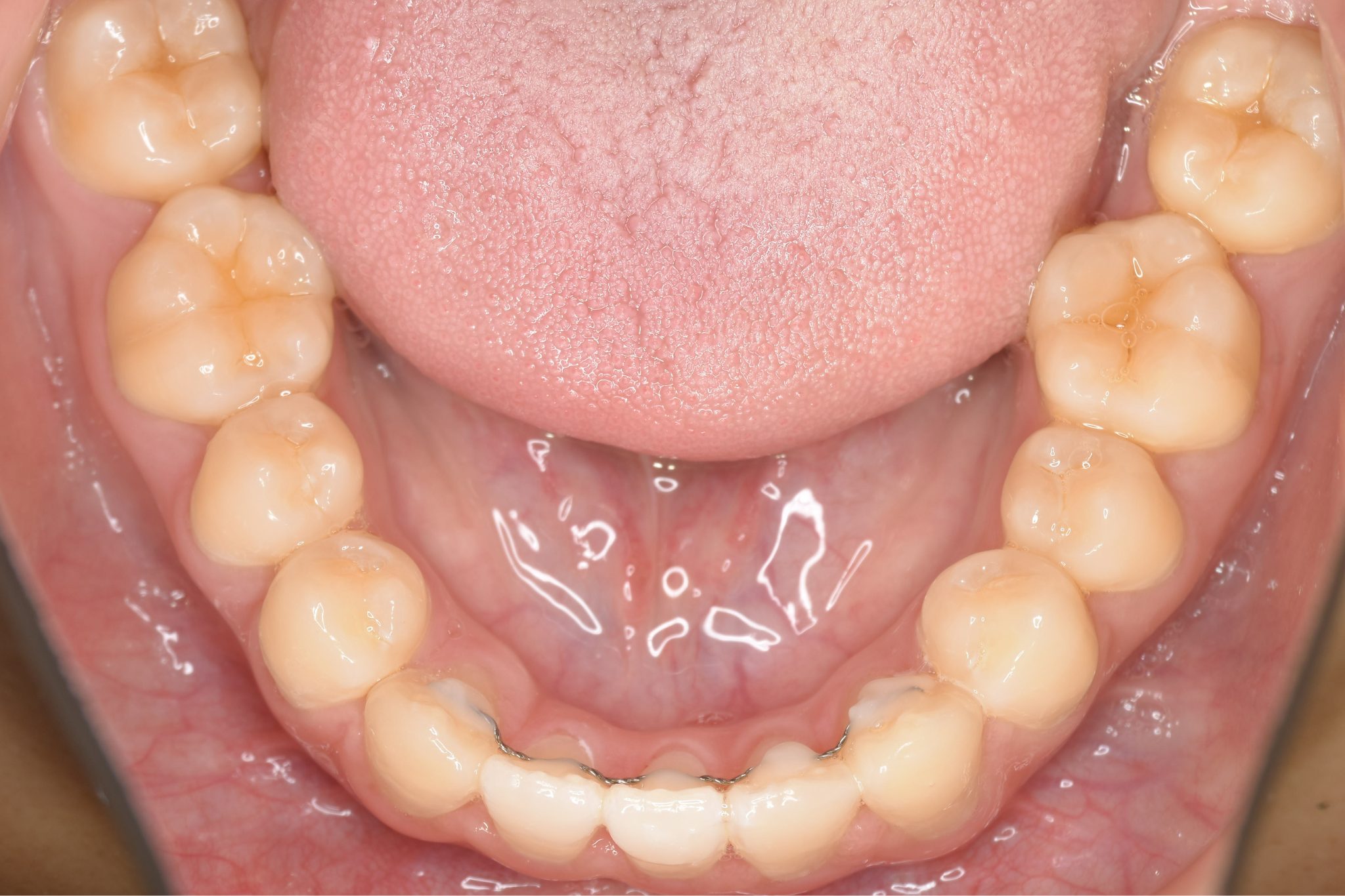 全顎ワイヤー矯正　症例_323