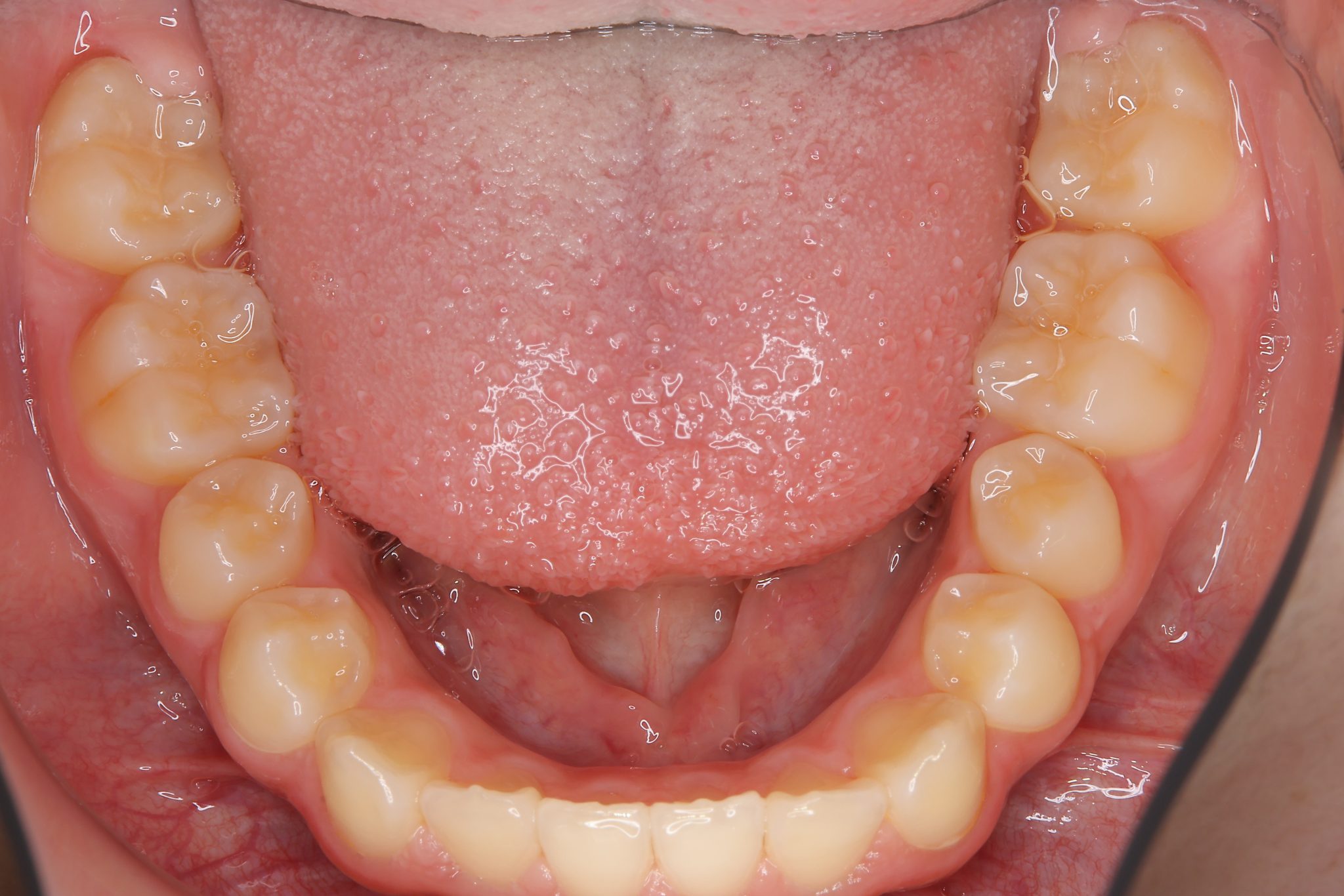 全顎ワイヤー矯正　症例_347