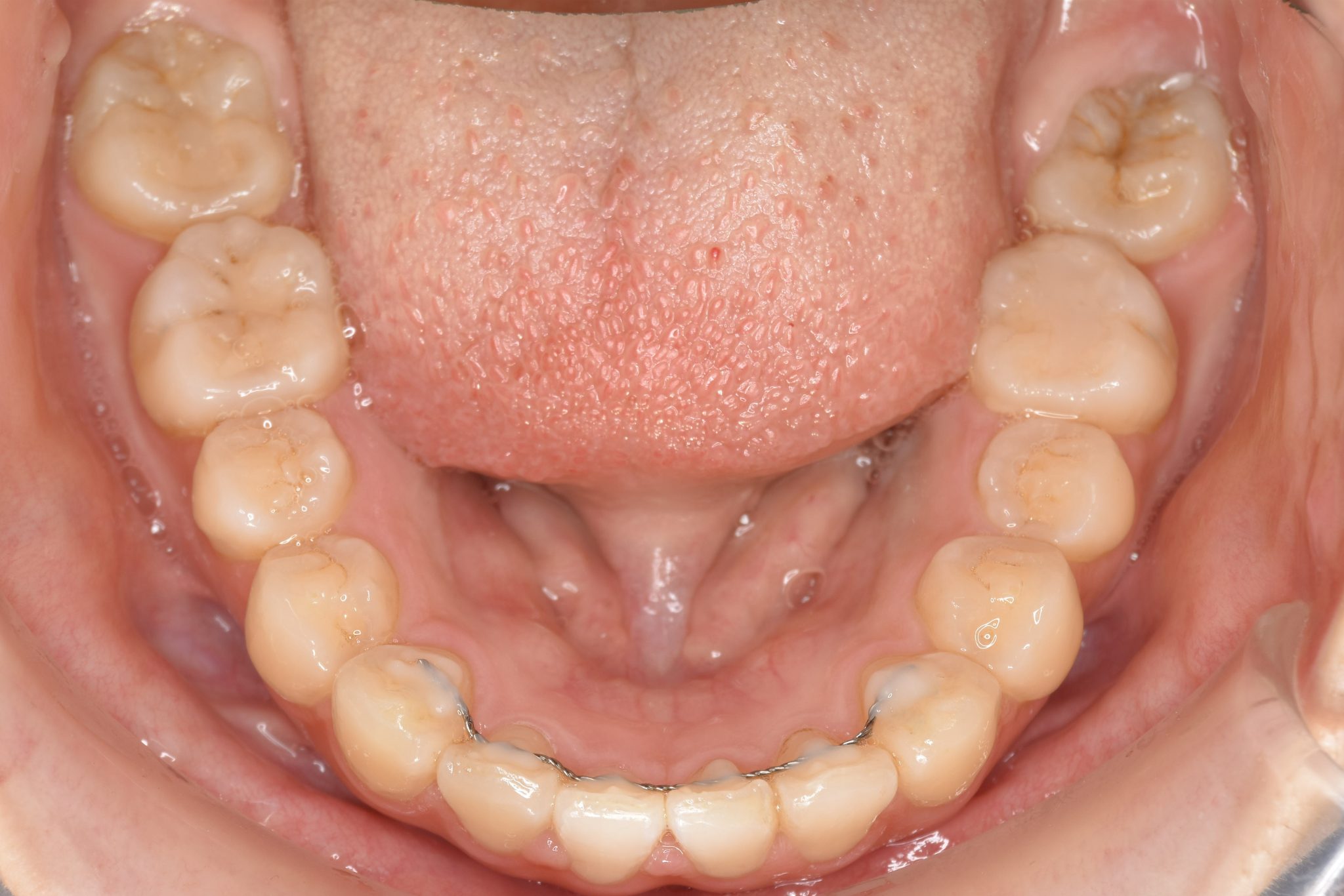 全顎ワイヤー矯正　症例_349