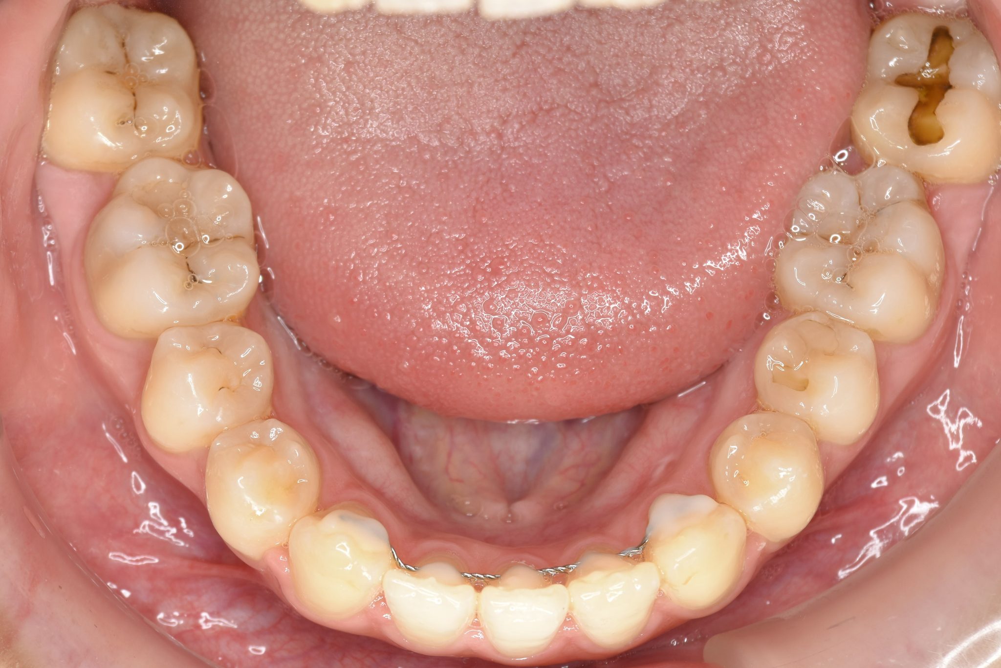 全顎ワイヤー矯正　症例_401